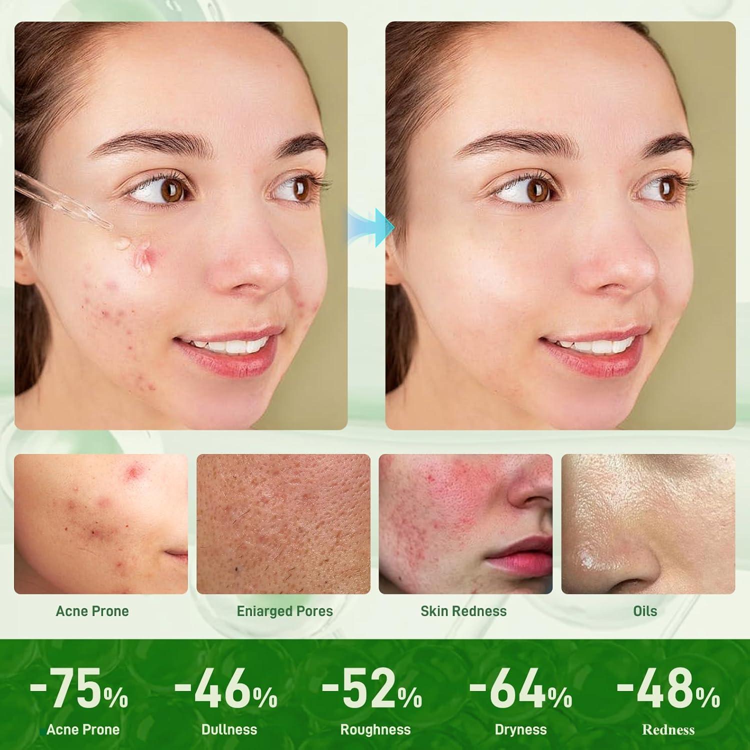 Suero Antiacné Onkessy 29.57 ml - 2% Ácido Salicílico y Niacinamida