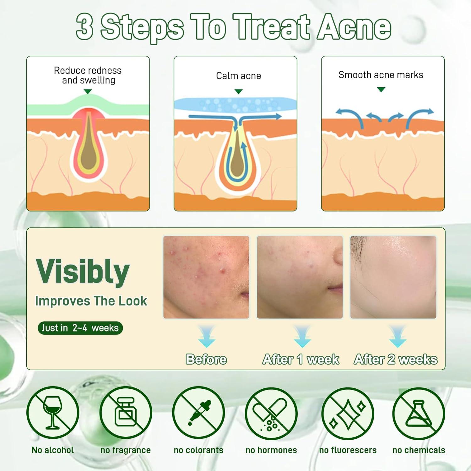 Suero Antiacné Onkessy 29.57 ml - 2% Ácido Salicílico y Niacinamida