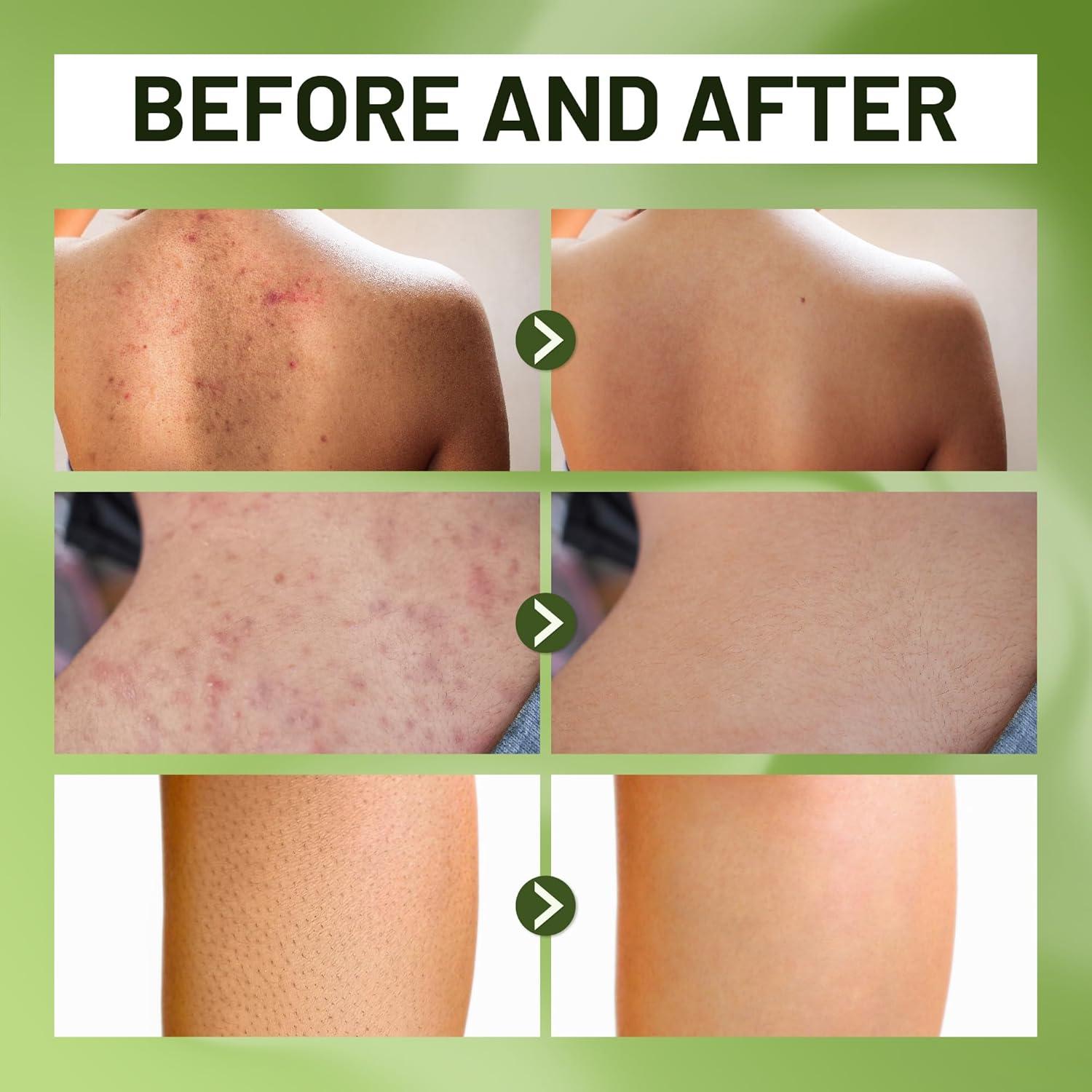 Gel de Ducha ABERA para Foliculitis y Acné 414 ml