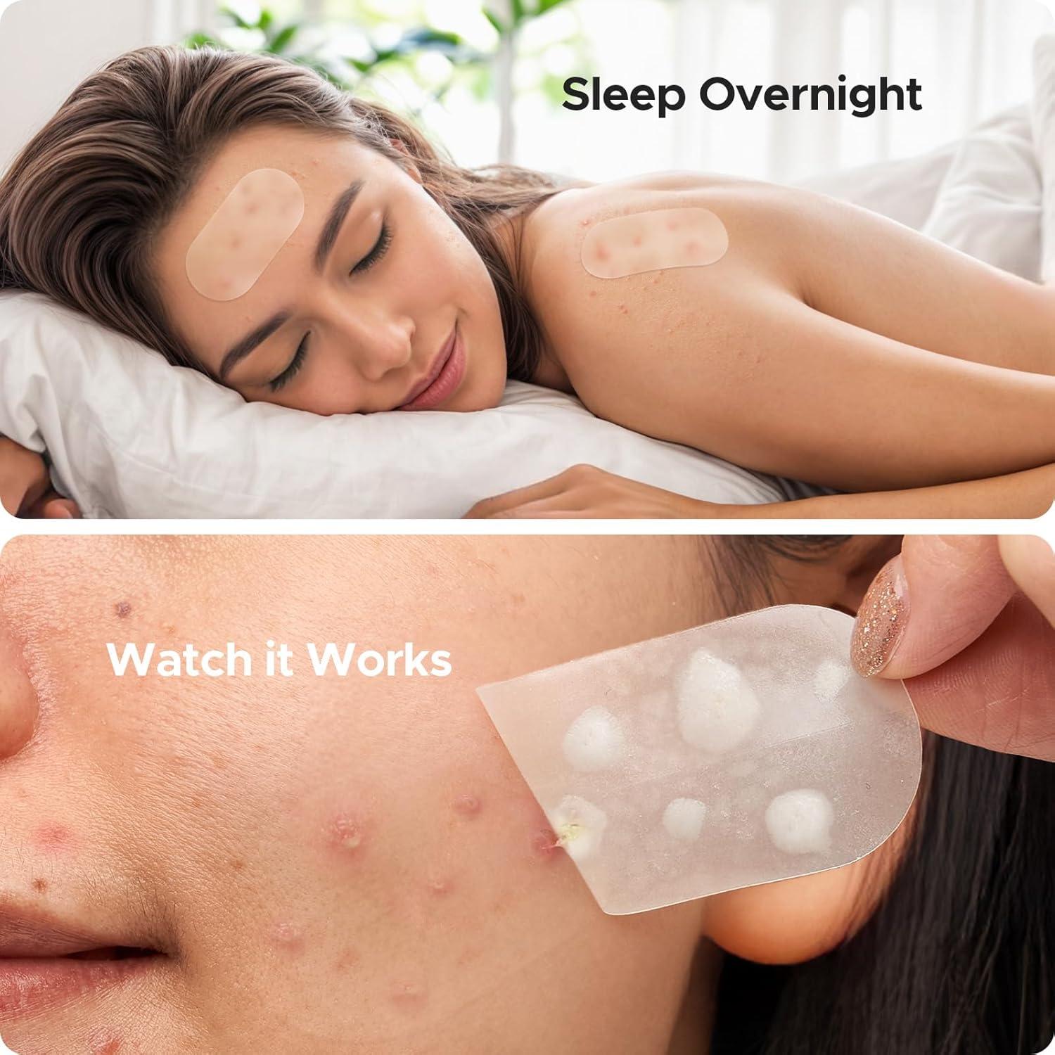 Parche Hidrocoloide XL TKTK para Acné - 124 Parches 60x30mm