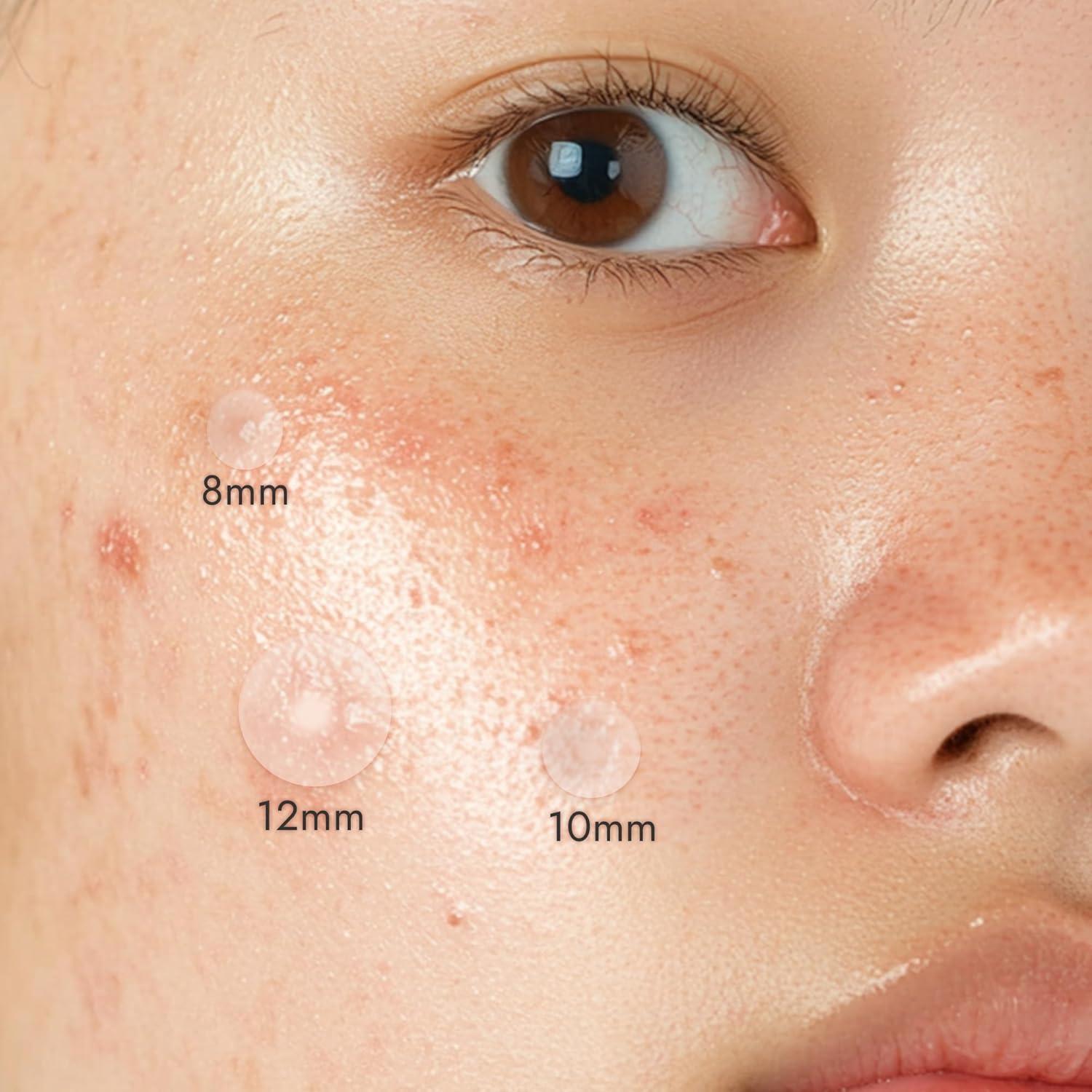 Parche Hidrocoloide para Acné Epielle Over-Zit 138 Unidades