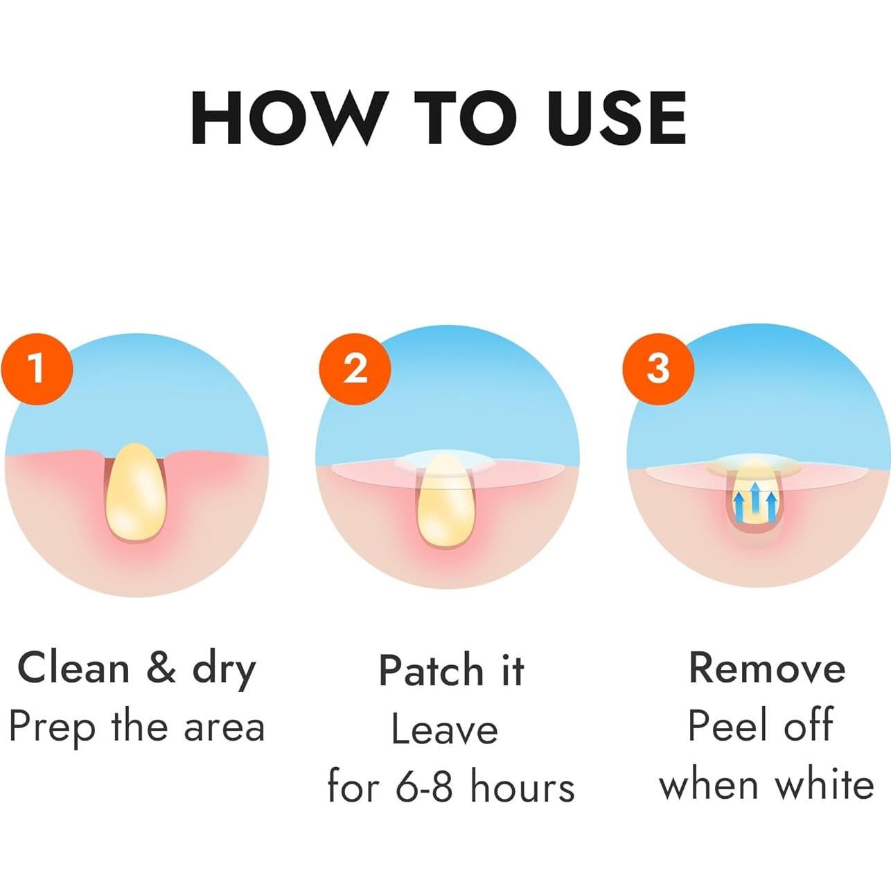 Parche Hidrocoloide para Acné Epielle Over-Zit 138 Unidades