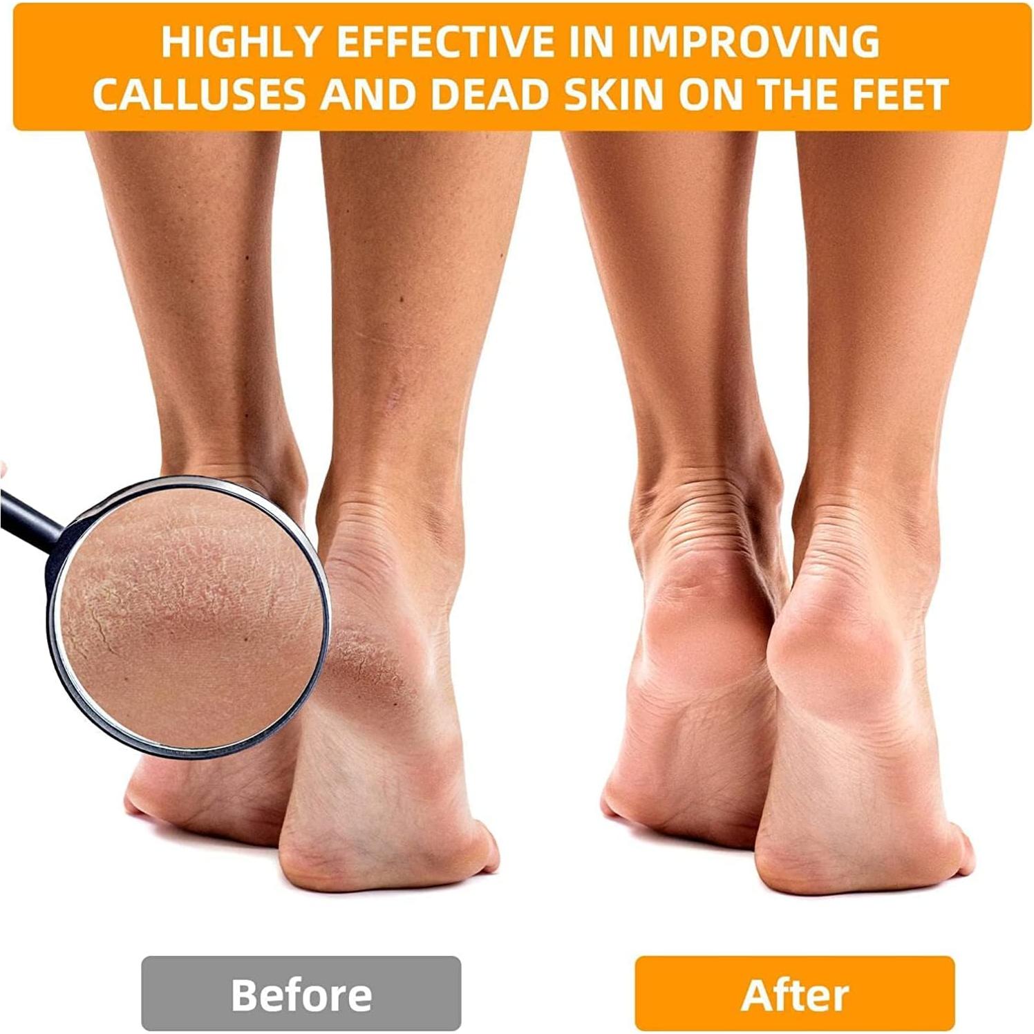 Lima para pies Paddsun 12 Pcs Removedor de callos Acero inoxidable