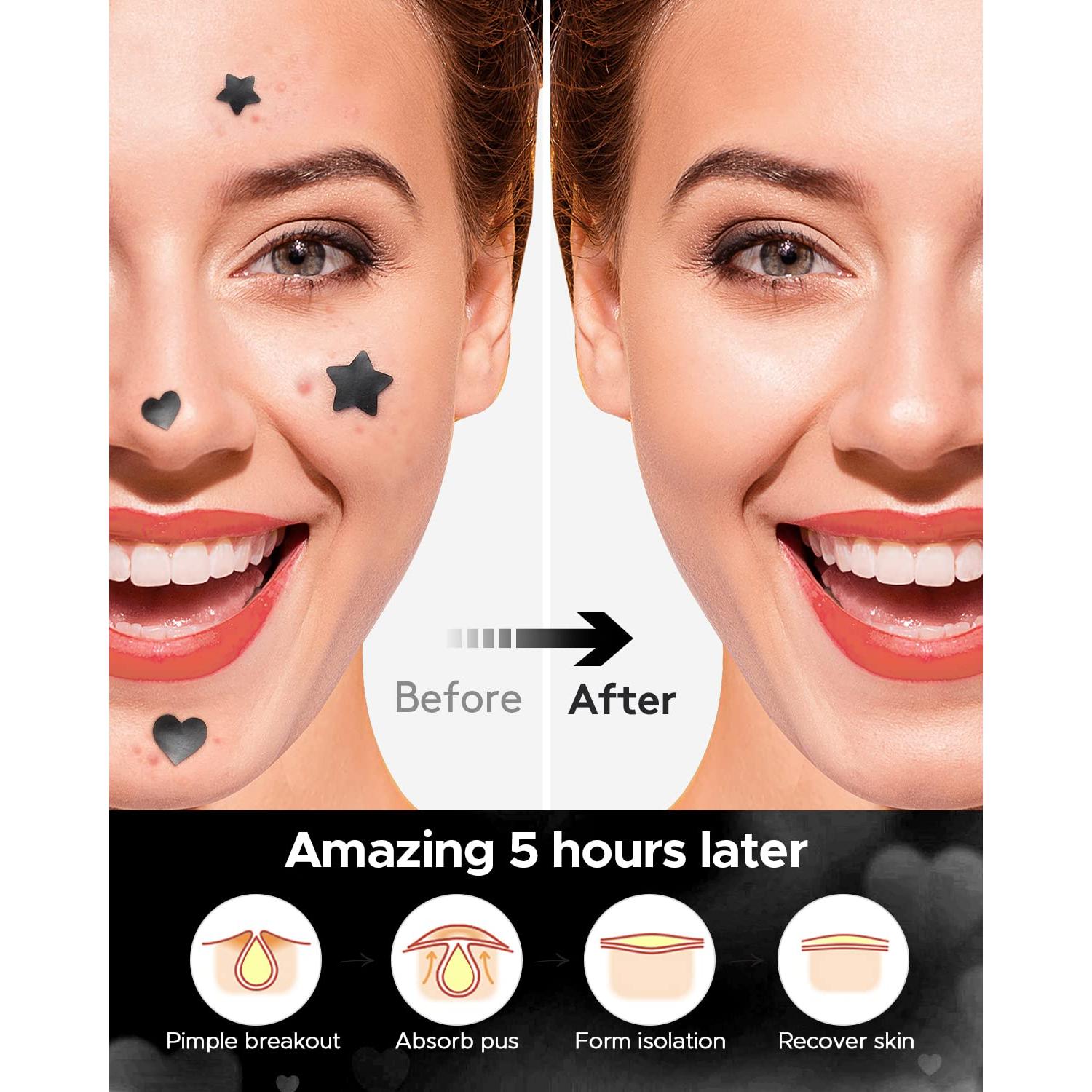 Parches Hidrocoloides para Acné LitBear - Estrella y Corazón Negro (108 Unidades)