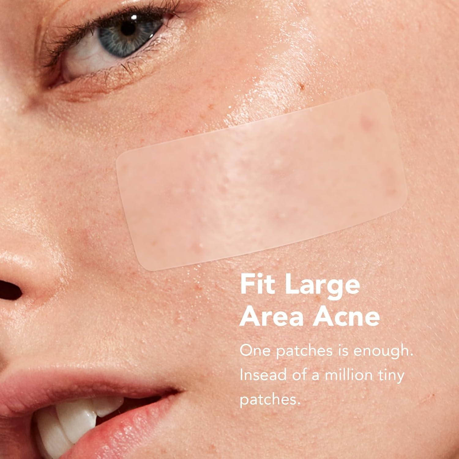 Parches para Granitos ZATKTK - 188 Parches Hidrocoloide