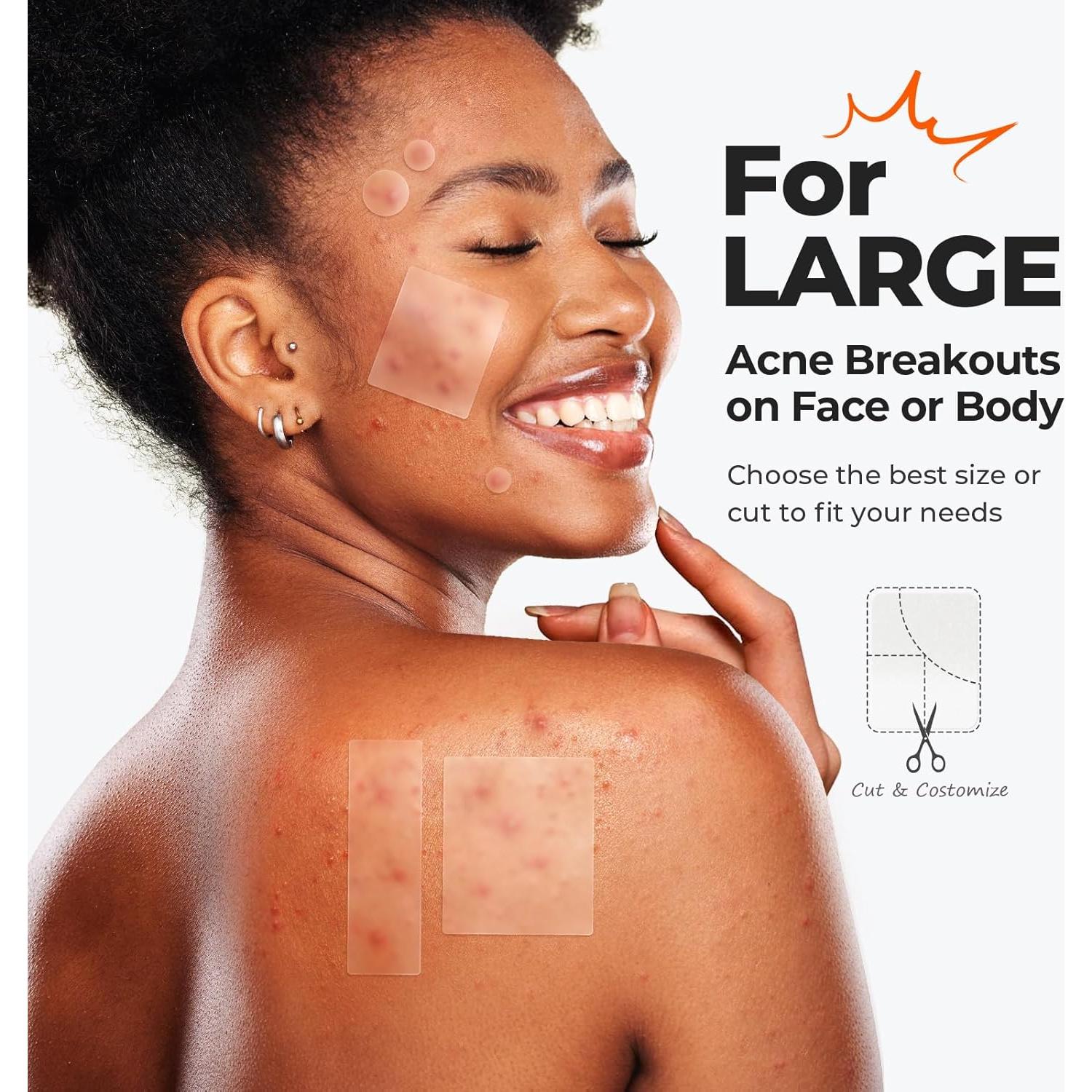 Parches para Acné TKTK Hidrocoloide Grande 92 Piezas 5 Tamaños