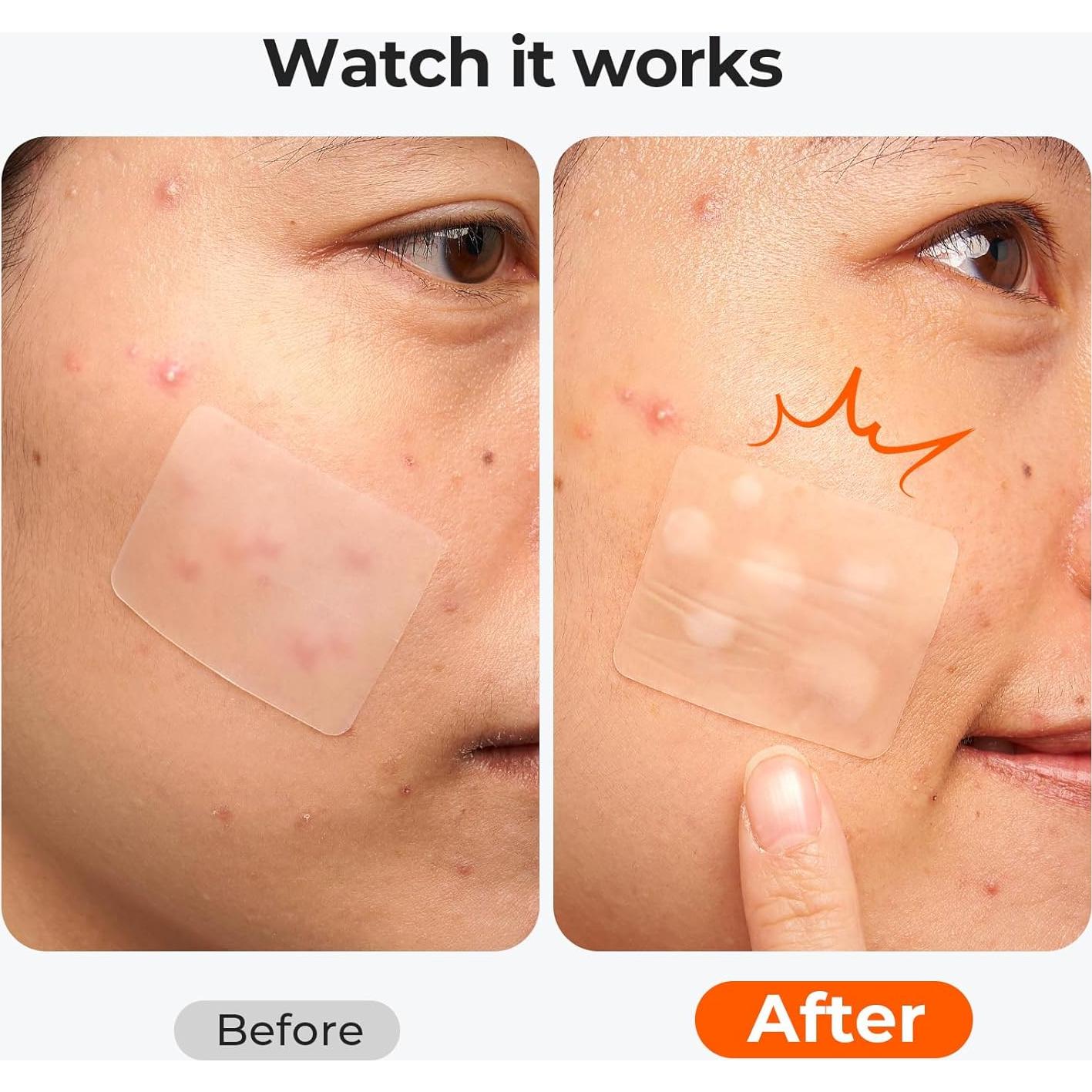 Parches para Acné TKTK Hidrocoloide Grande 92 Piezas 5 Tamaños