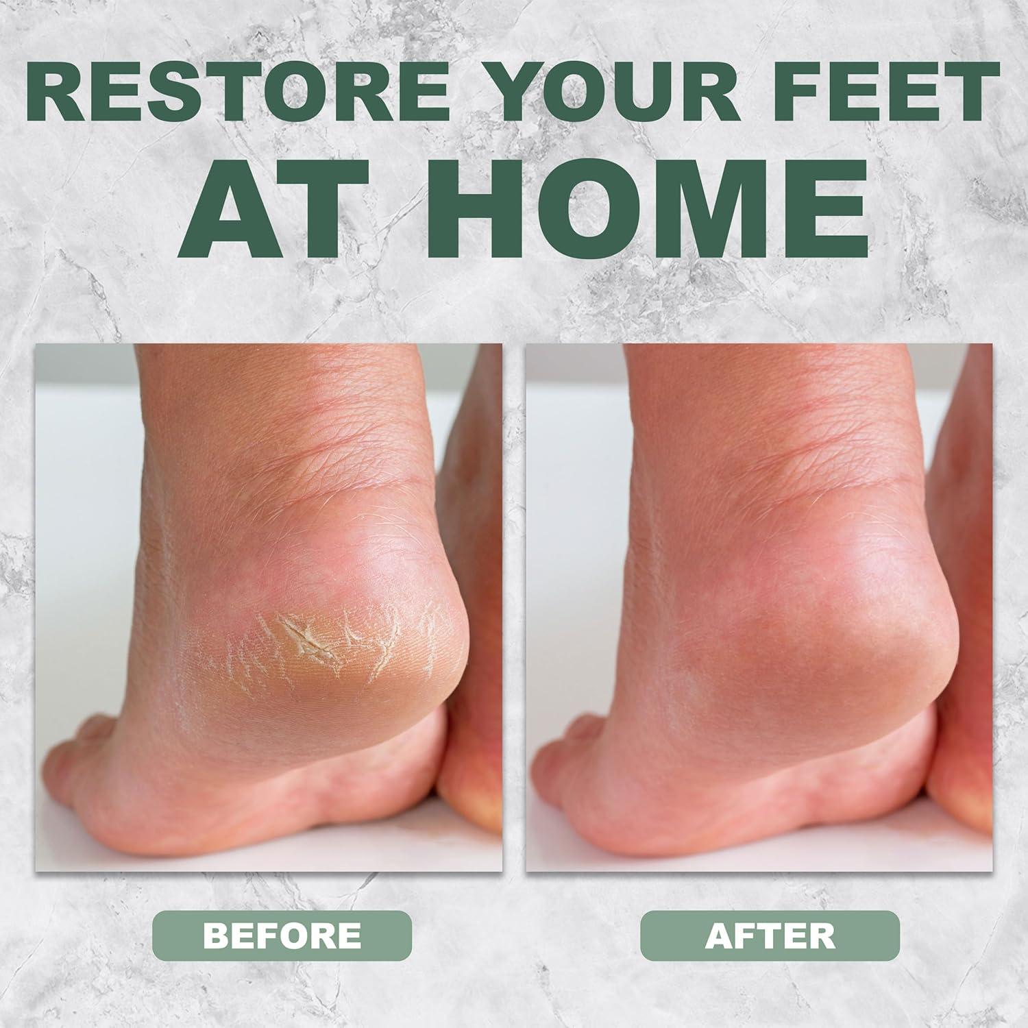 Removedor de Callos MHB Lila - Lima Profesional para Pies