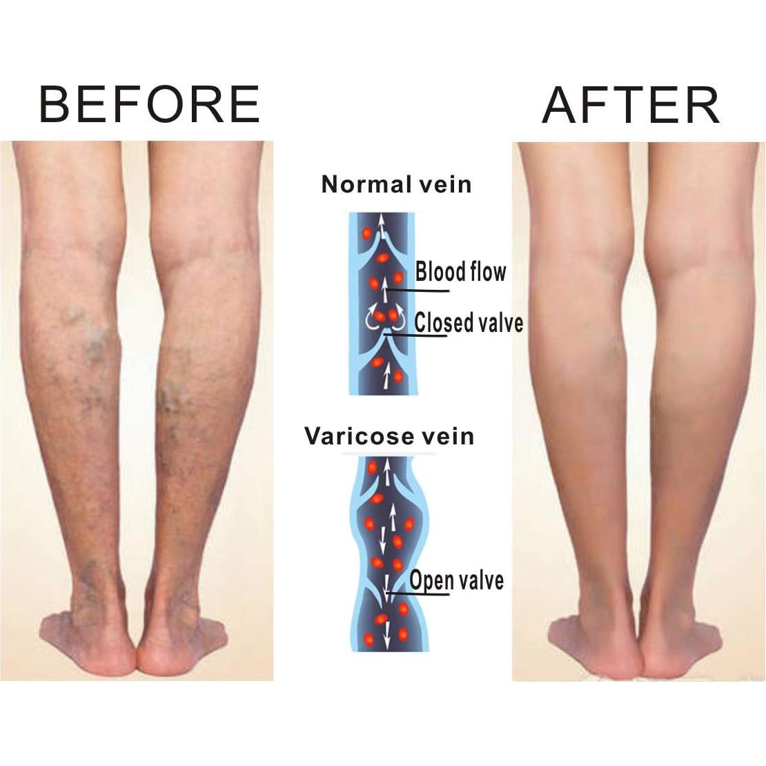 Calcetines de Compresión Abiertos SKUNDU 15-20 mmHg 6 Pares