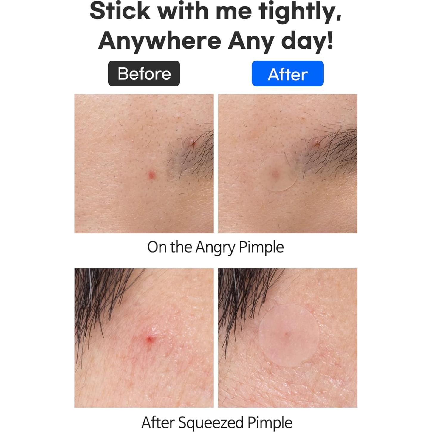 Parche Hidrocoloide TIA'M para Acné - 24 Unidades