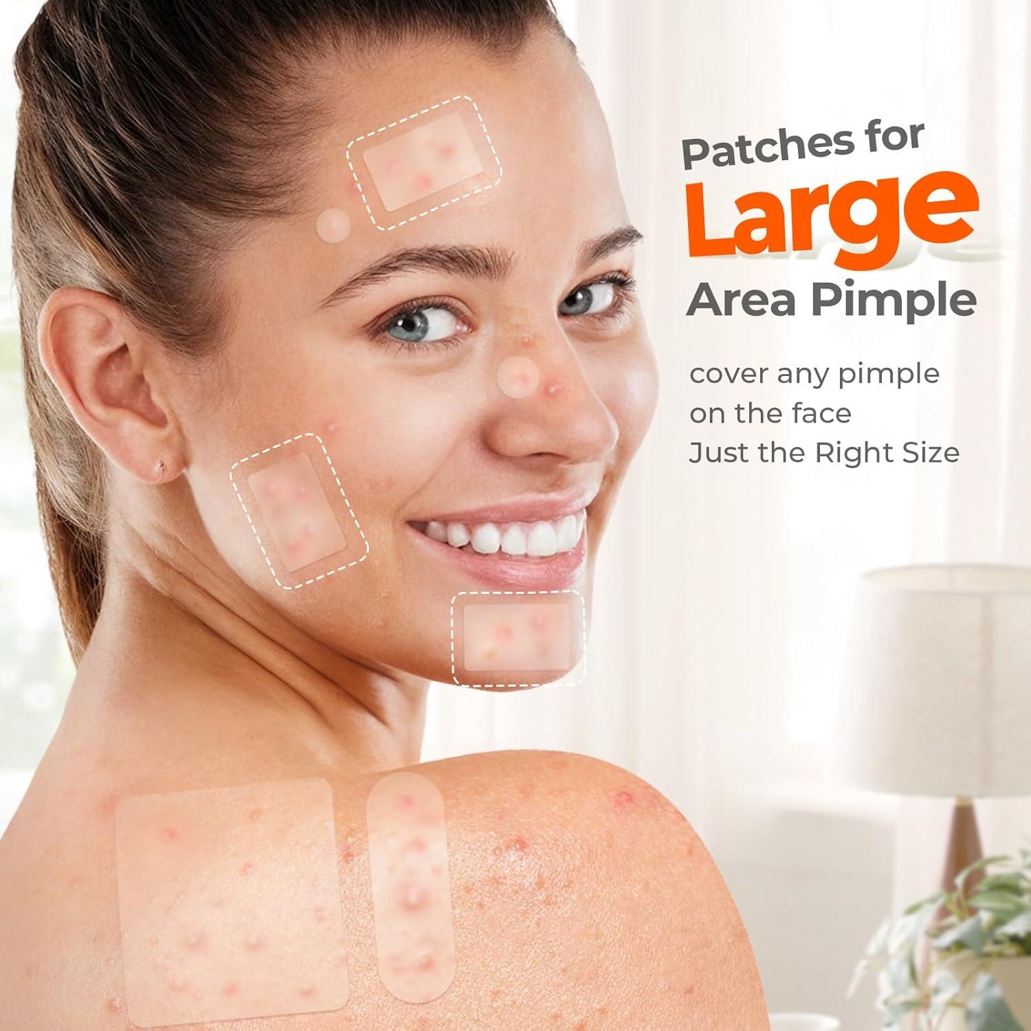 Parche Hidrocoloide para Acné TKTK - 142 Parches en 7 Tamaños