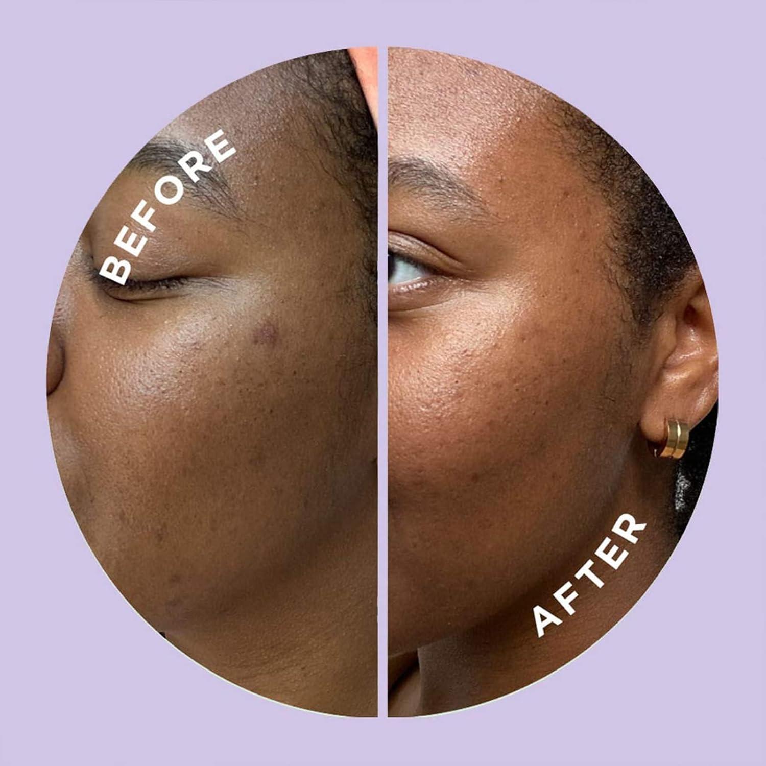 Parche Microdart ZitSticka Hyperfade para Manchas Post-Acné - 4 Unidades