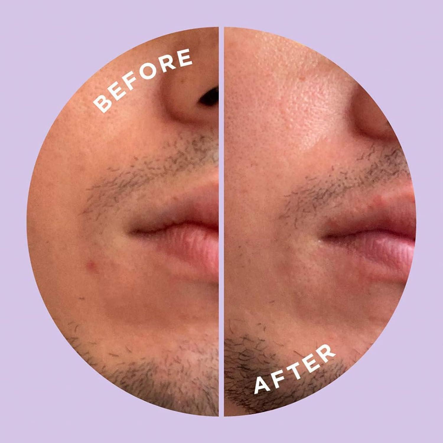 Parche Microdart ZitSticka Hyperfade para Manchas Post-Acné - 4 Unidades