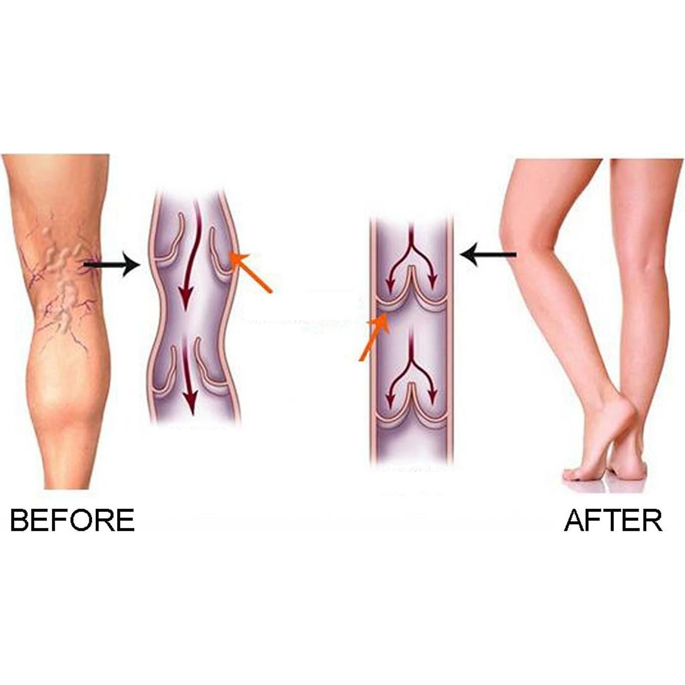 Medias de Compresión Maternidad Kingbridal 15-20 mmHg Mujeres