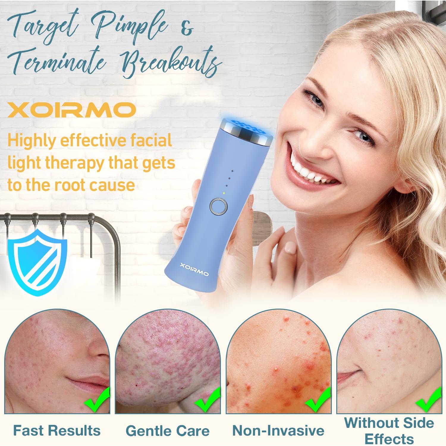 Varita Terapia Luz Azul LED XOIRMO para Acné - Compacta y Efectiva