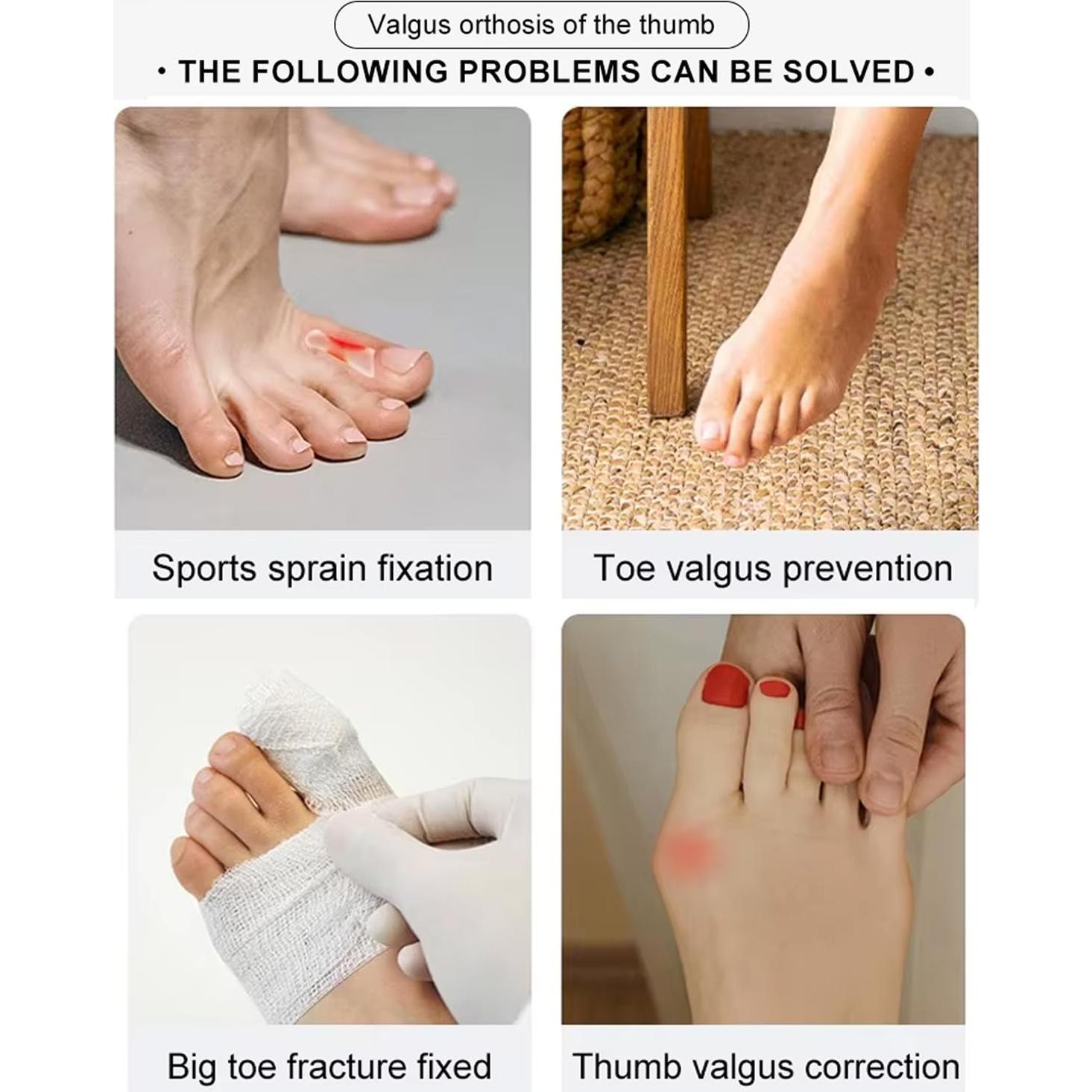 2 Correctores de Juanetes Lonicerkz para Alivio de Hallux Valgus