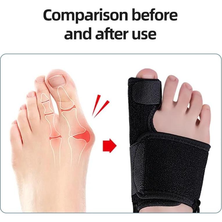 2 Correctores de Juanetes Lonicerkz para Alivio de Hallux Valgus