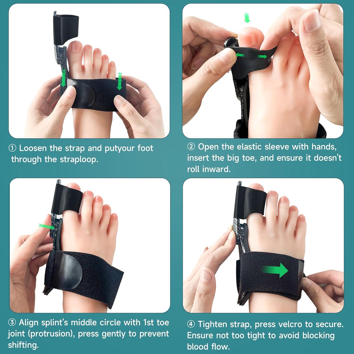 Corrector de Juanetes Kandwin BC-01-B para Alivio del Dolor