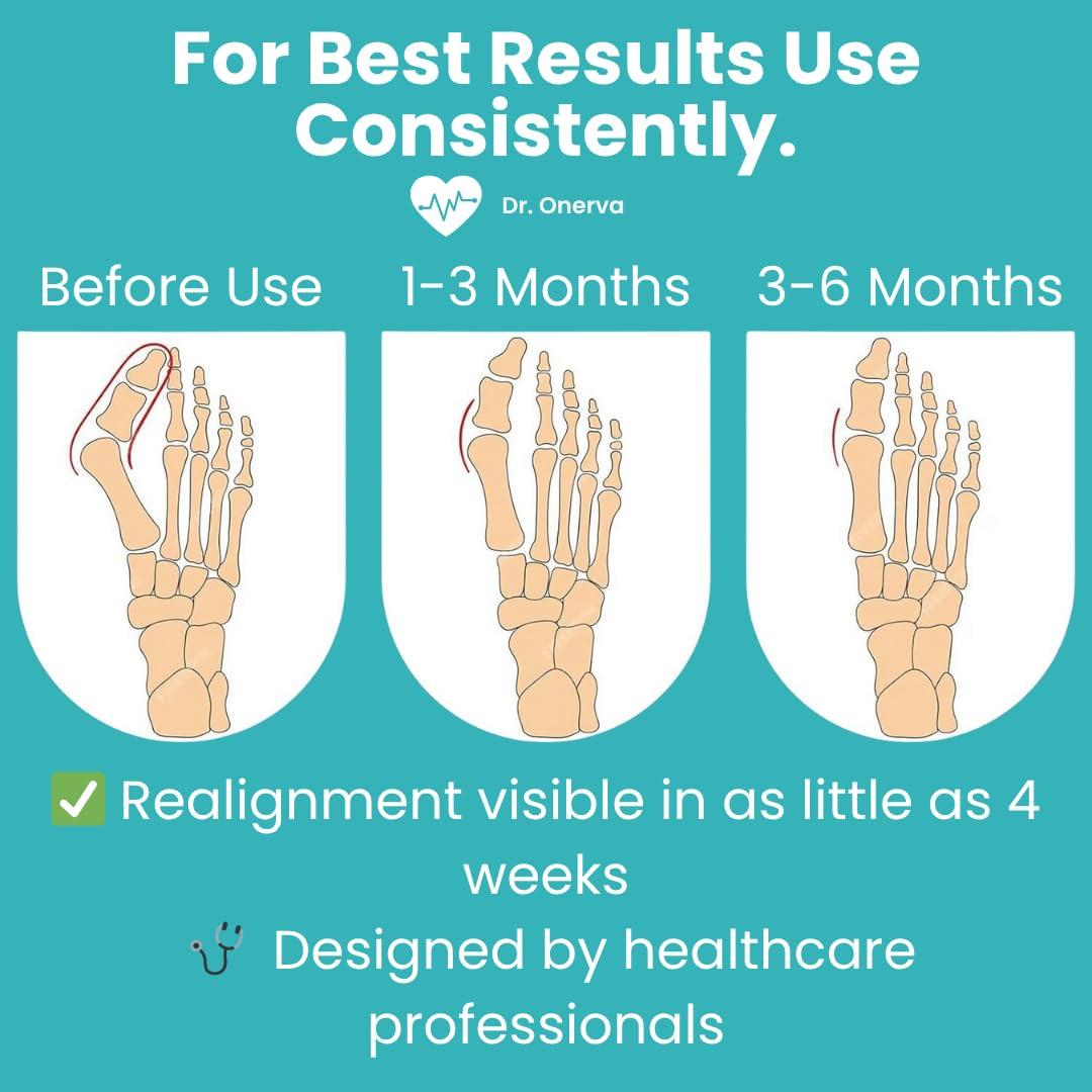 Corrector de Juanetes ONERVA 2PC Alivio Hallux Valgus