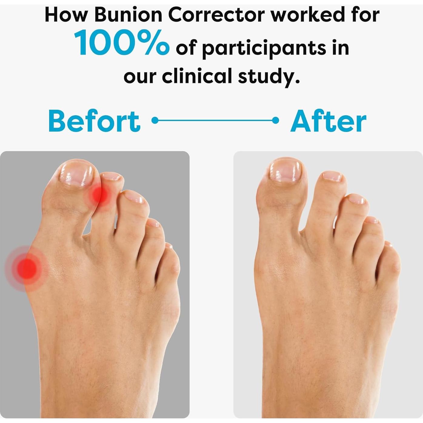 Corrector de Juanetes FURTAA - Alivio para Hallux Valgus, Tamaño Medio