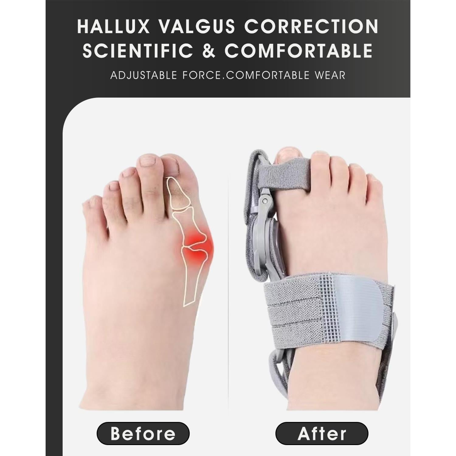 Corrector de Juanetes para Niños Qlonn - Férula Ajustable Gris