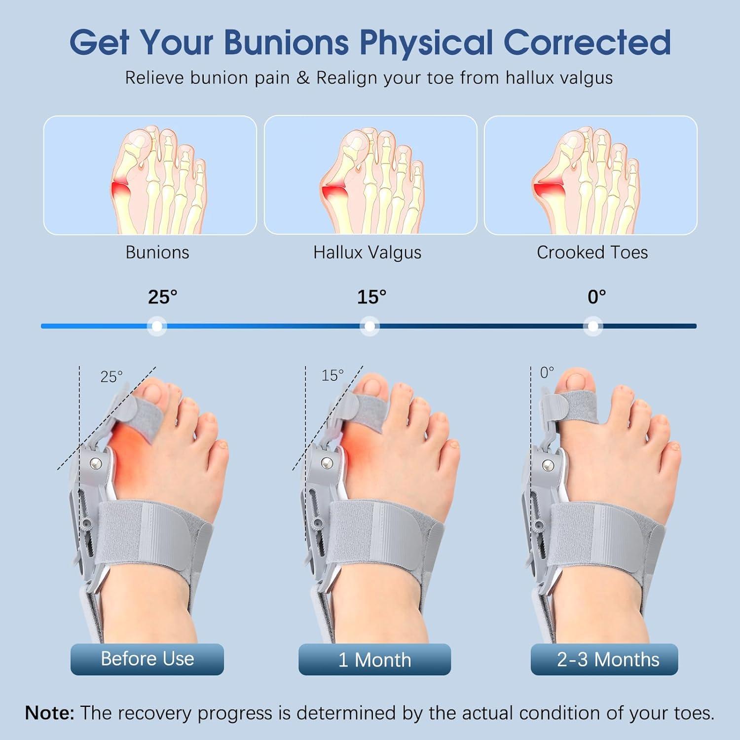 Corrector de Juanetes KASHEVI Ajustable para Alivio del Dolor