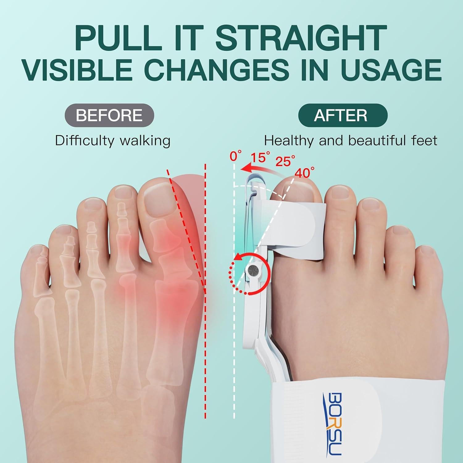 Corrector de Juanetes Blanco Shandong Bosu Ajustable Ortopédico