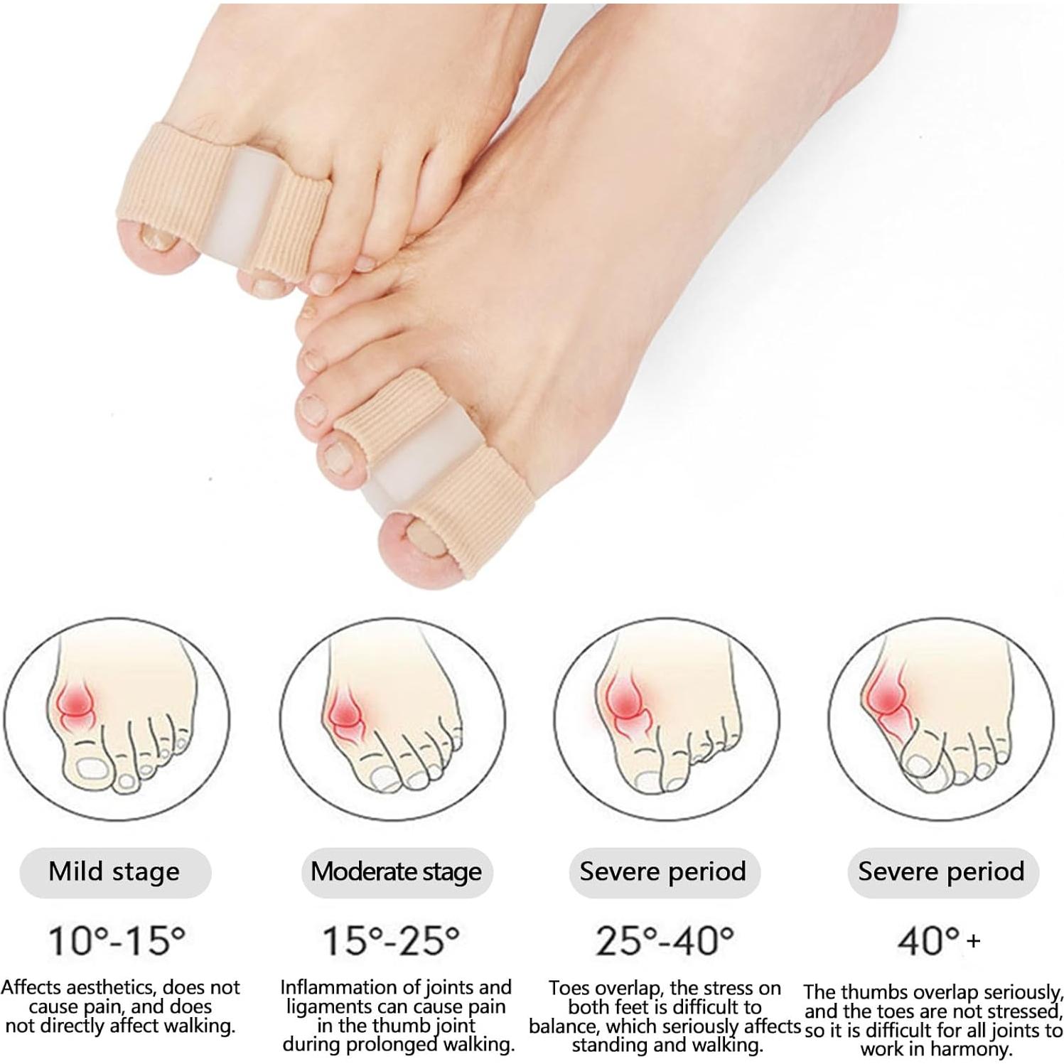 Separadores de Dedos de Gel LJHYSD para Juanetes y Hallux Valgus