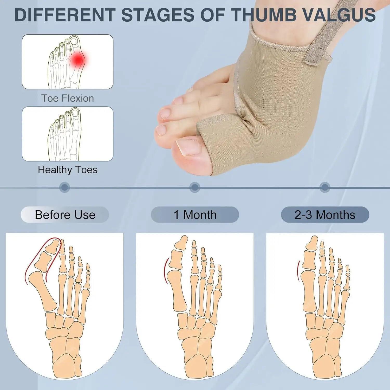 Corrector de Juanetes GLASSMARC 2PCS Alivio Dolor Transpirable