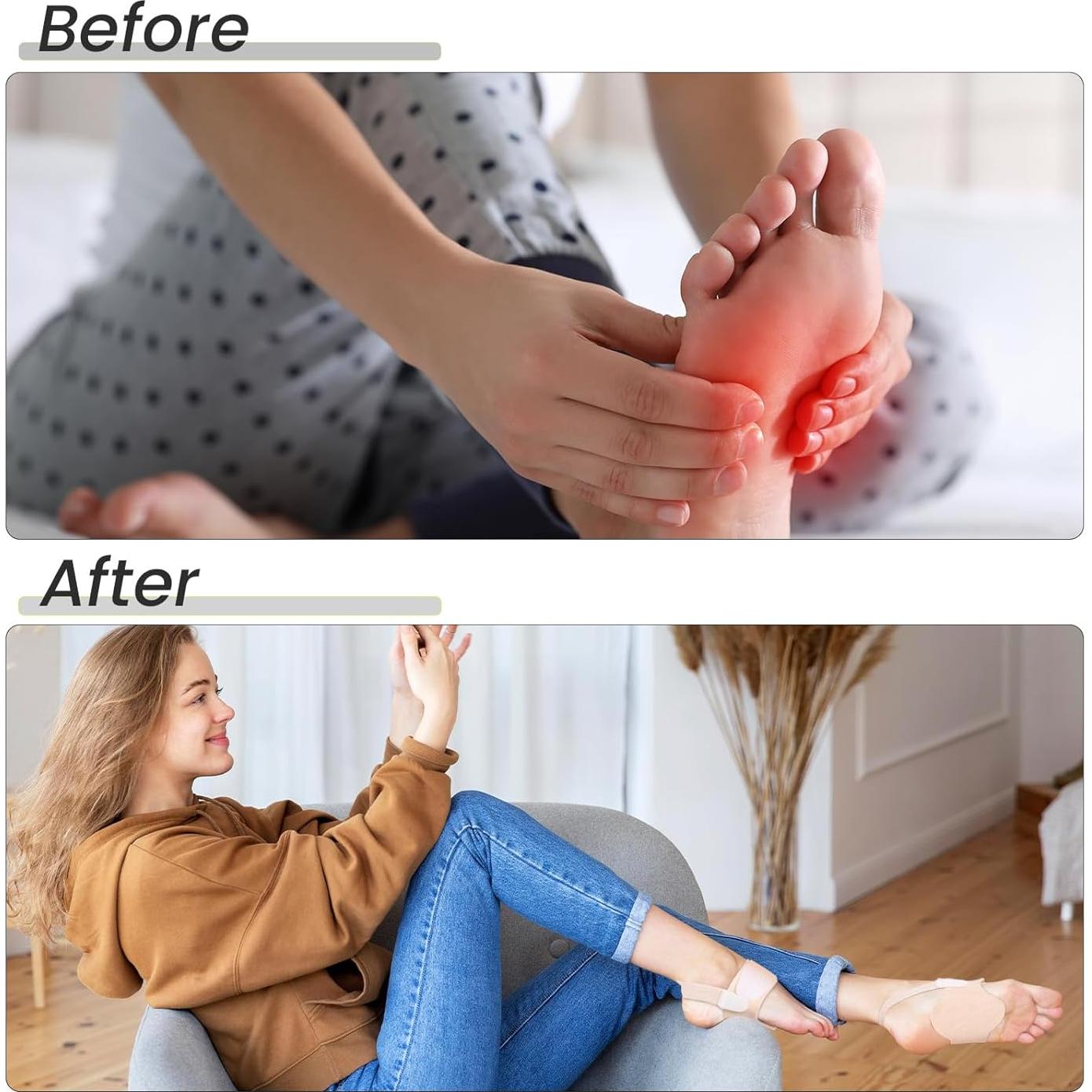 Soportes de Arco Bukihome Ajustables para Fascitis Plantar - Beige