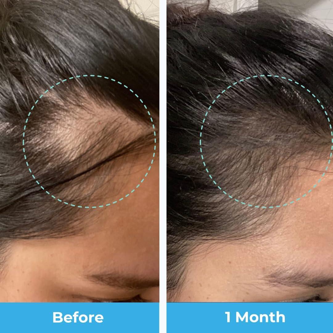 Vitaminas Postparto para Pérdida de Cabello Baby Blues - Gominolas Veganas con Biotina y Colágeno