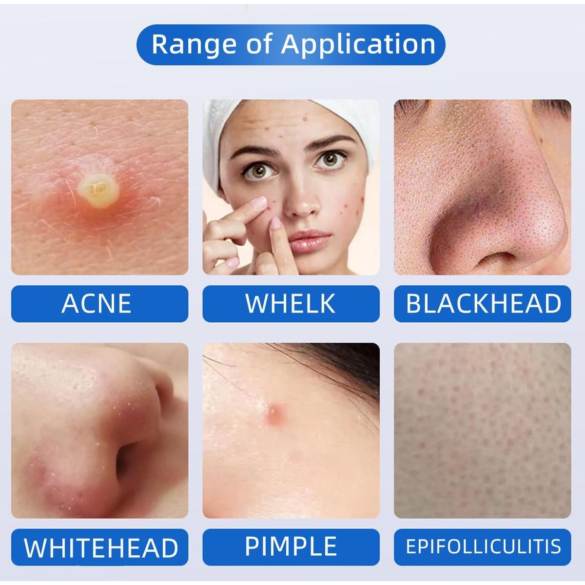 Paquete de 2 herramientas desechables estériles para acné BeiLaiSun