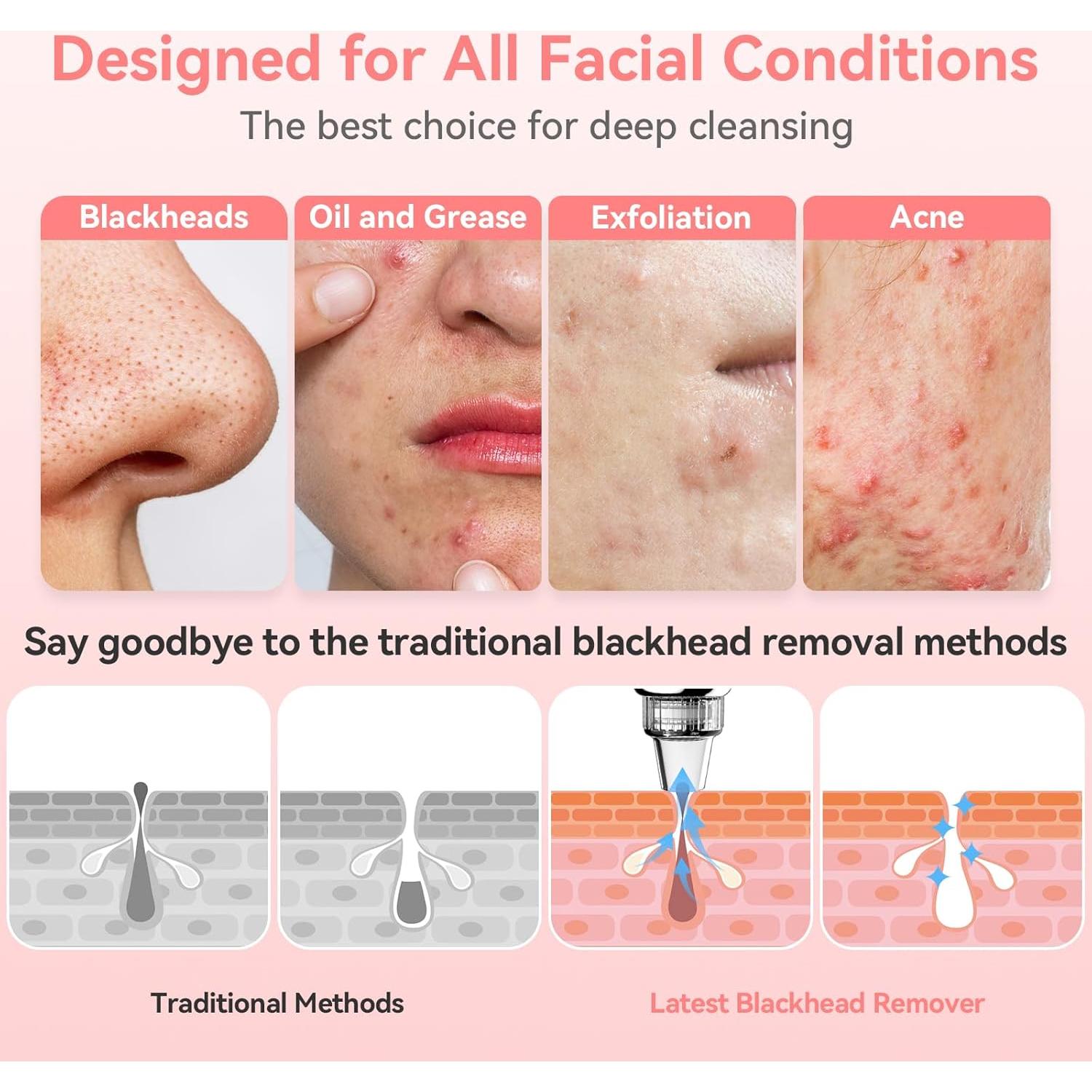 Extractor de Puntos Negros FREESHOW JHF-15 Recargable USB