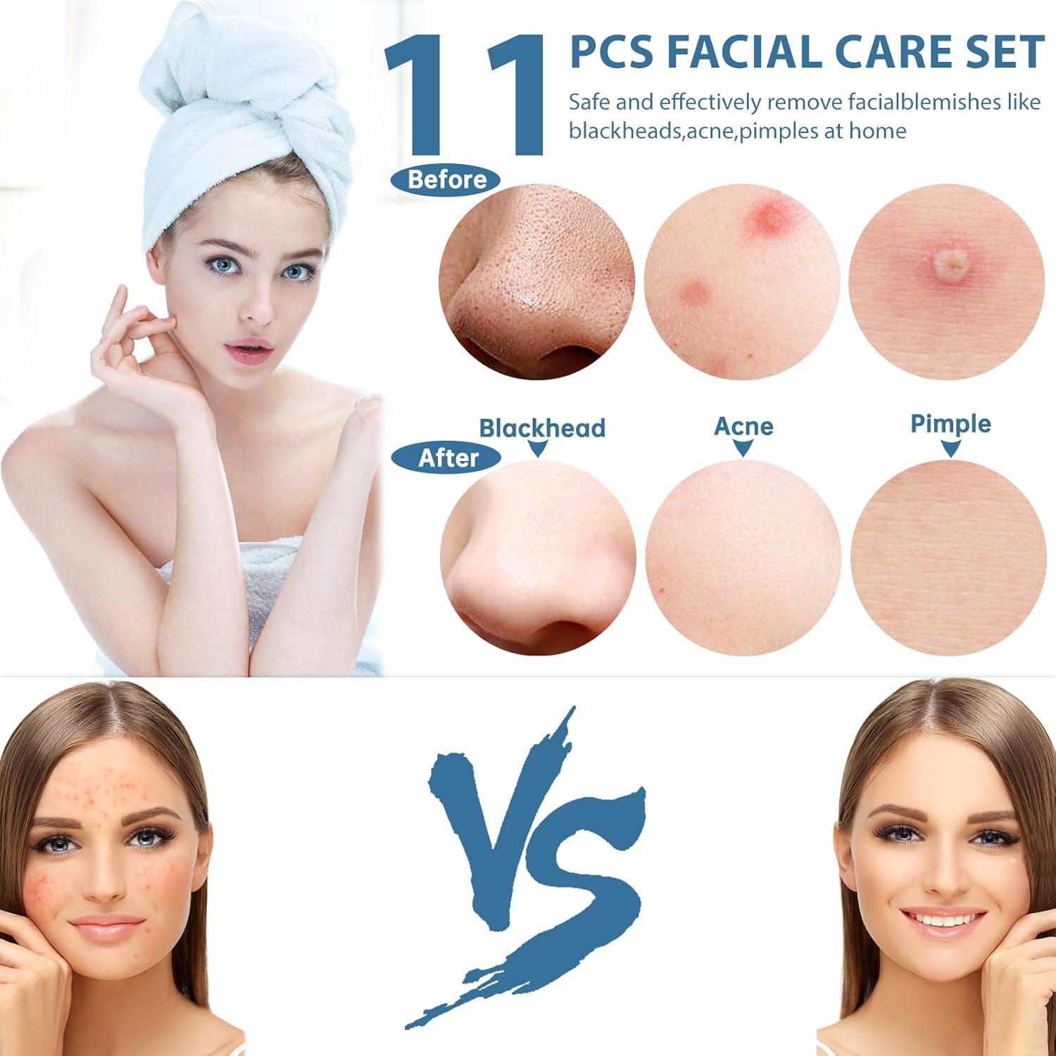 Kit de Herramientas Extractoras de Puntos Negros SBAILL 11PCS