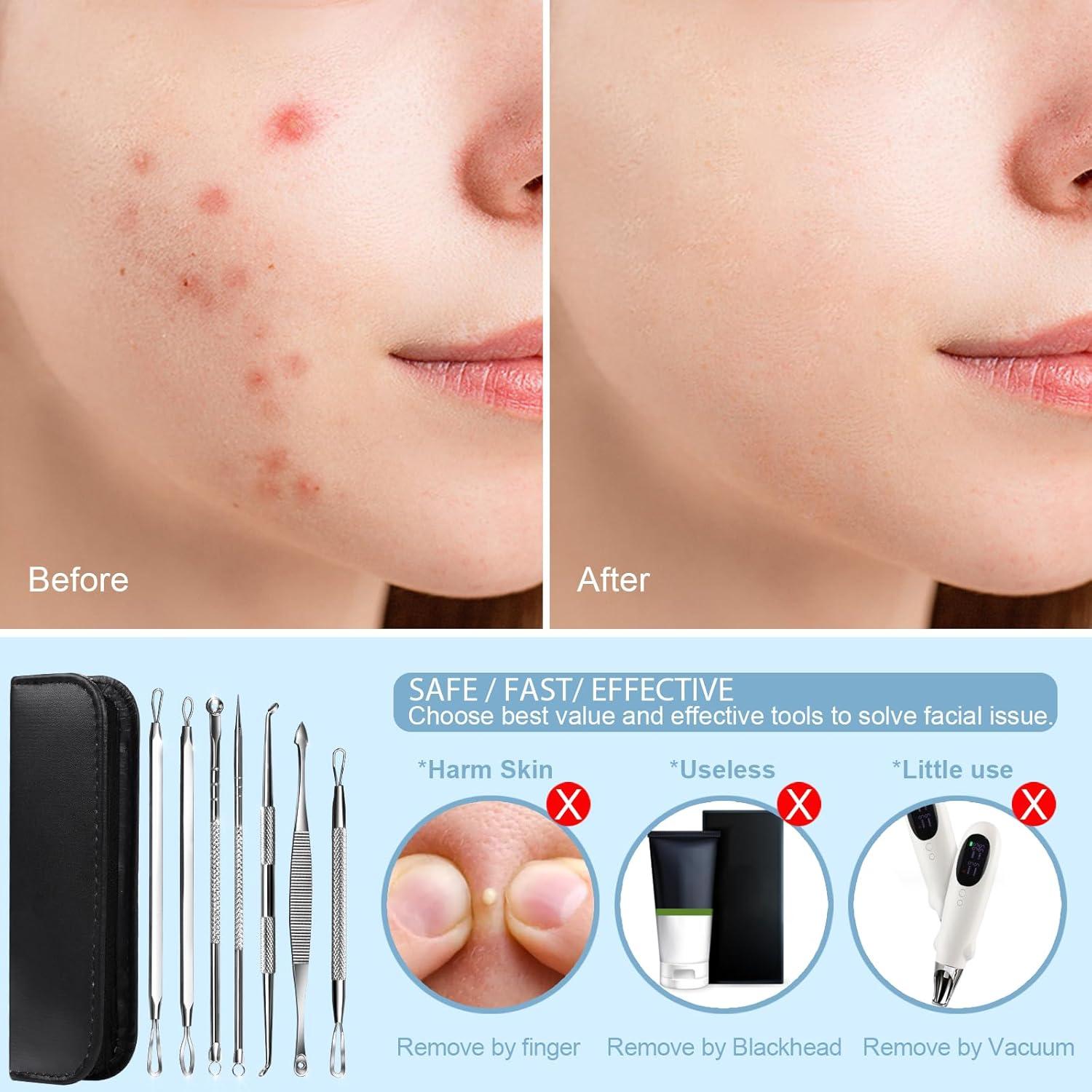 Kit de Herramientas para Extraer Espinillas Teenitor 7 en 1