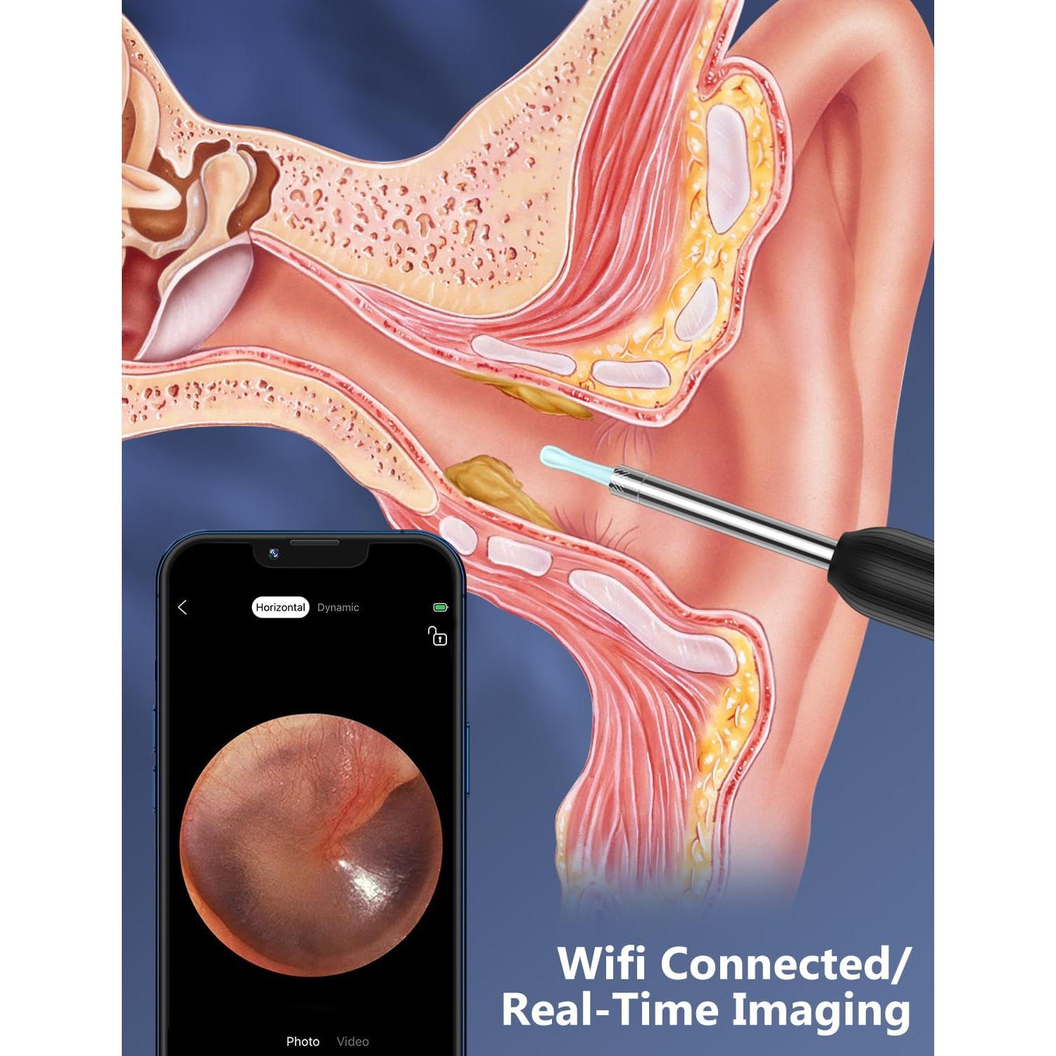 Kit Eliminador de Cerumen VITCOCO con Cámara 1080P y 4 Modos