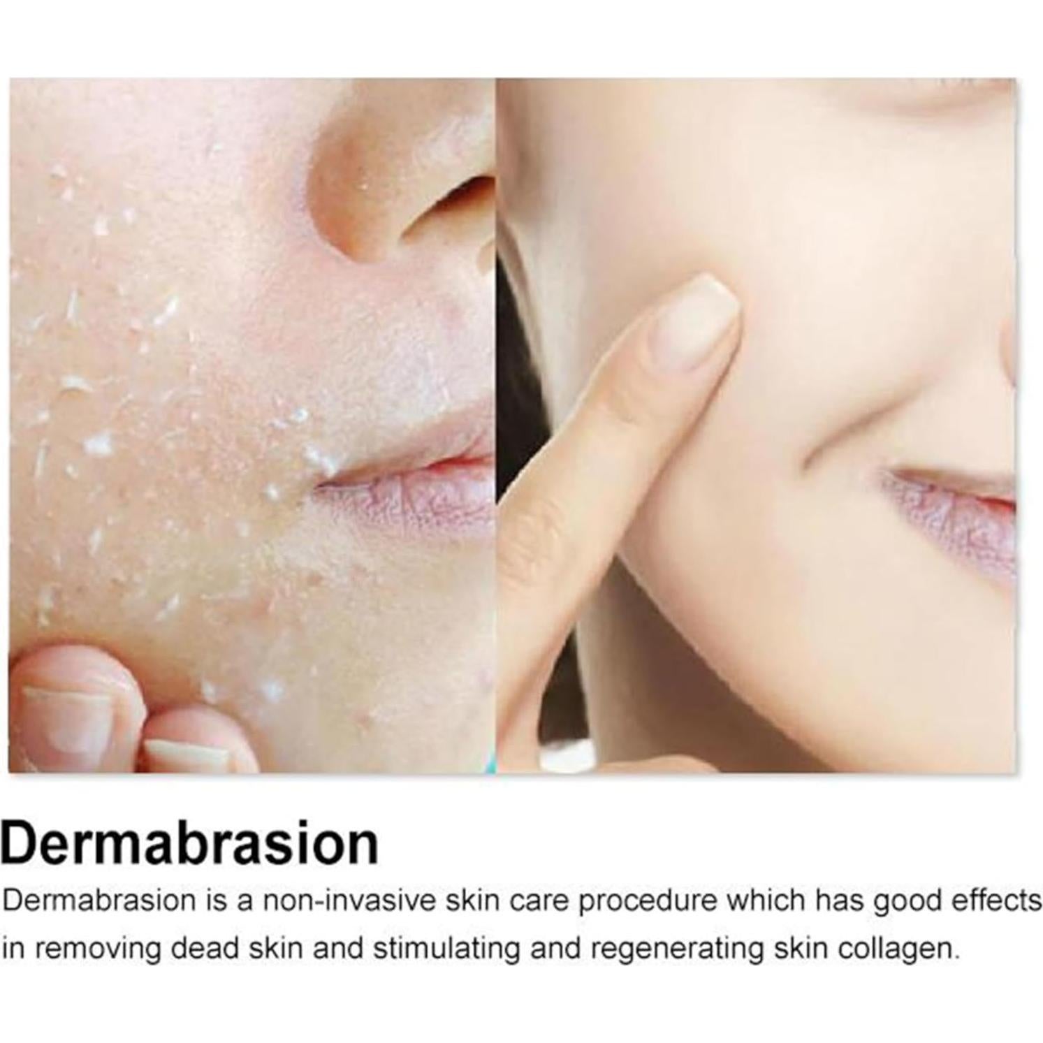 Máquina de Microdermoabrasi&oacute;n Diamante Elitzia ETLB198W 130VA