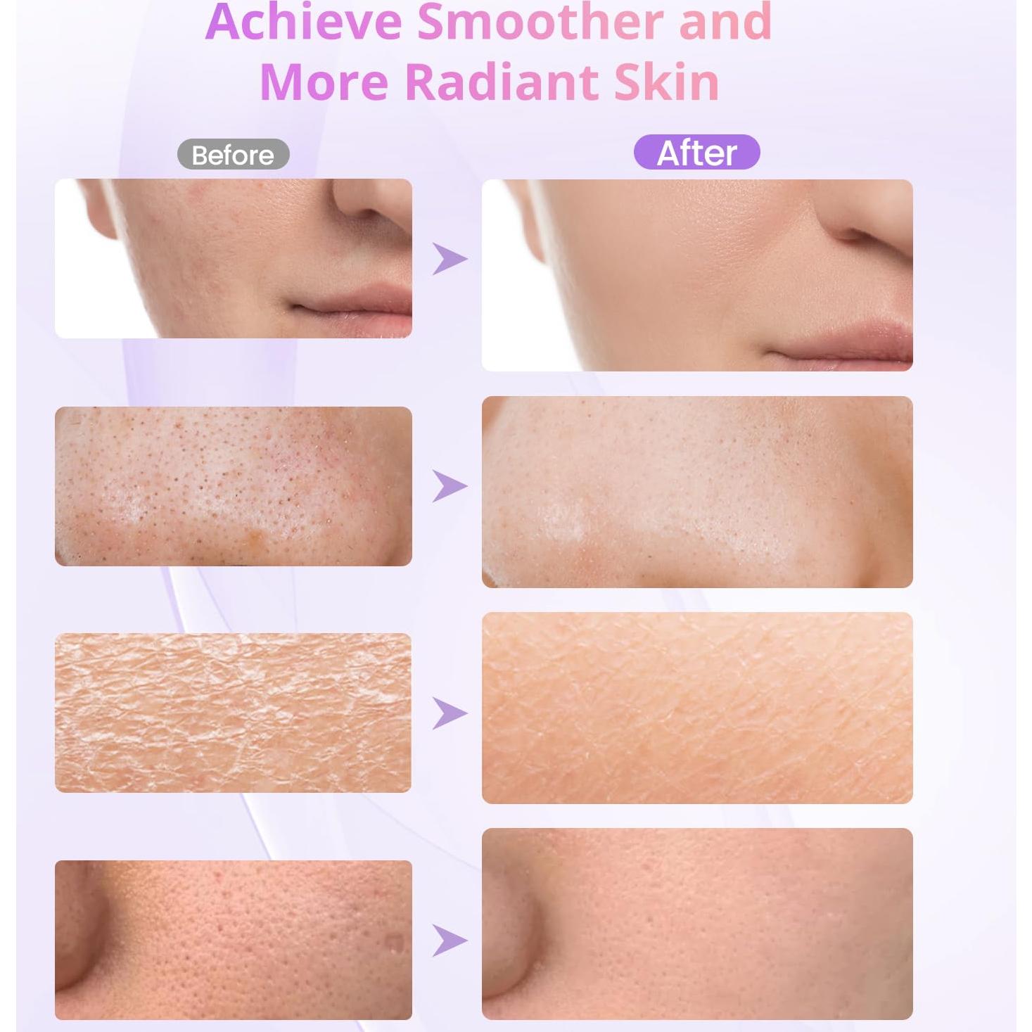 Máquina de Microdermoabrasión UNOISETION 3 en 1 para Cuidado Facial