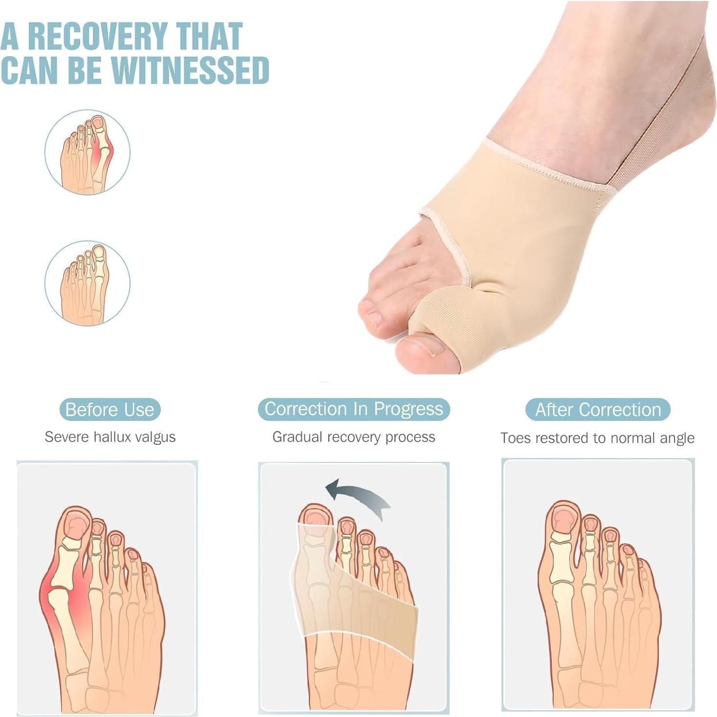 Corrector de Juanetes WELEQUT 2-Pack Beige Alivio Hallux Valgus