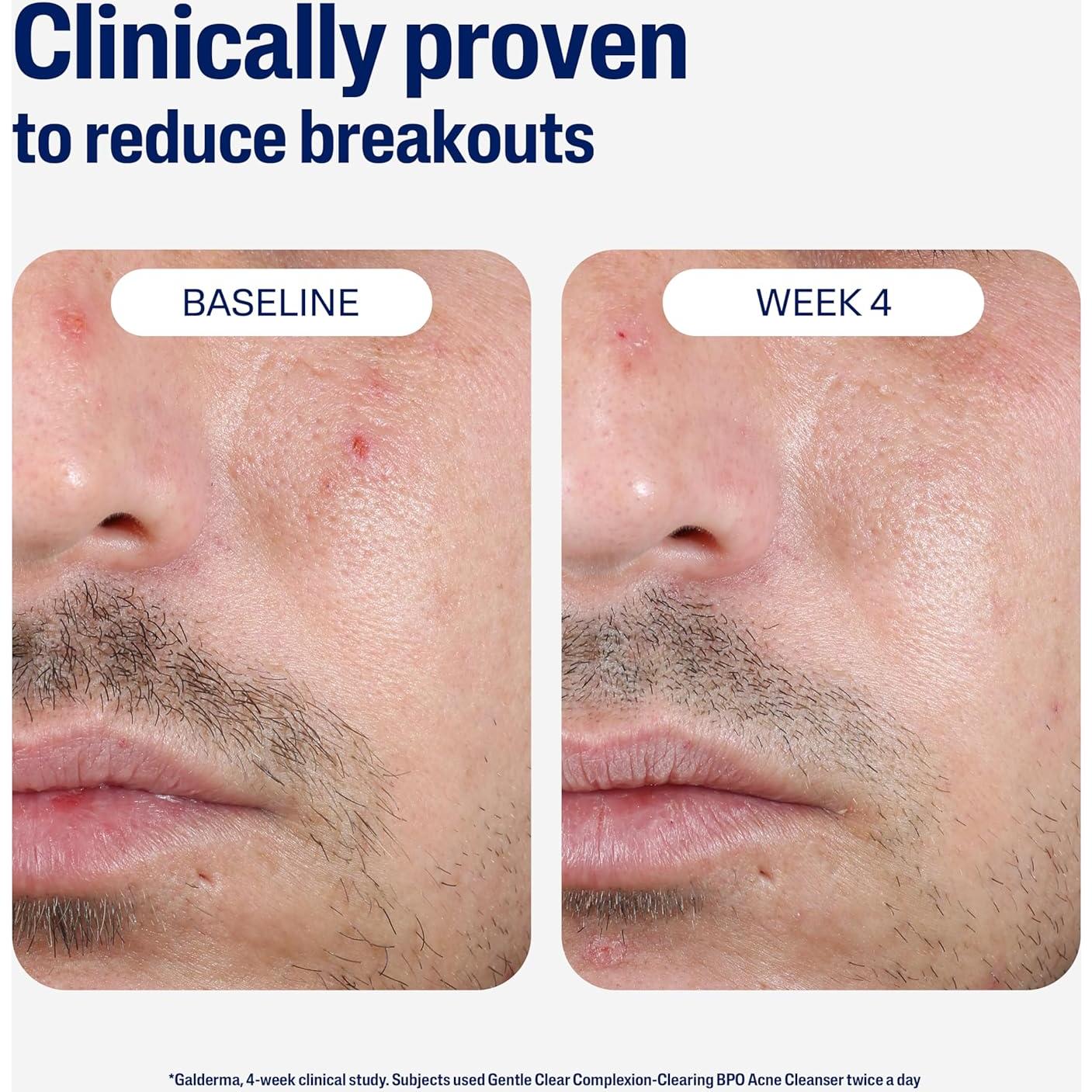 Limpiador Suave Cetaphil para Acné 2.6% BPO 119g Piel Sensible