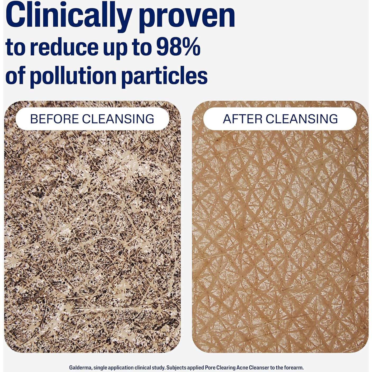 Cetaphil Limpiador de Acné Suave 236 ml con 2% Ácido Salicílico