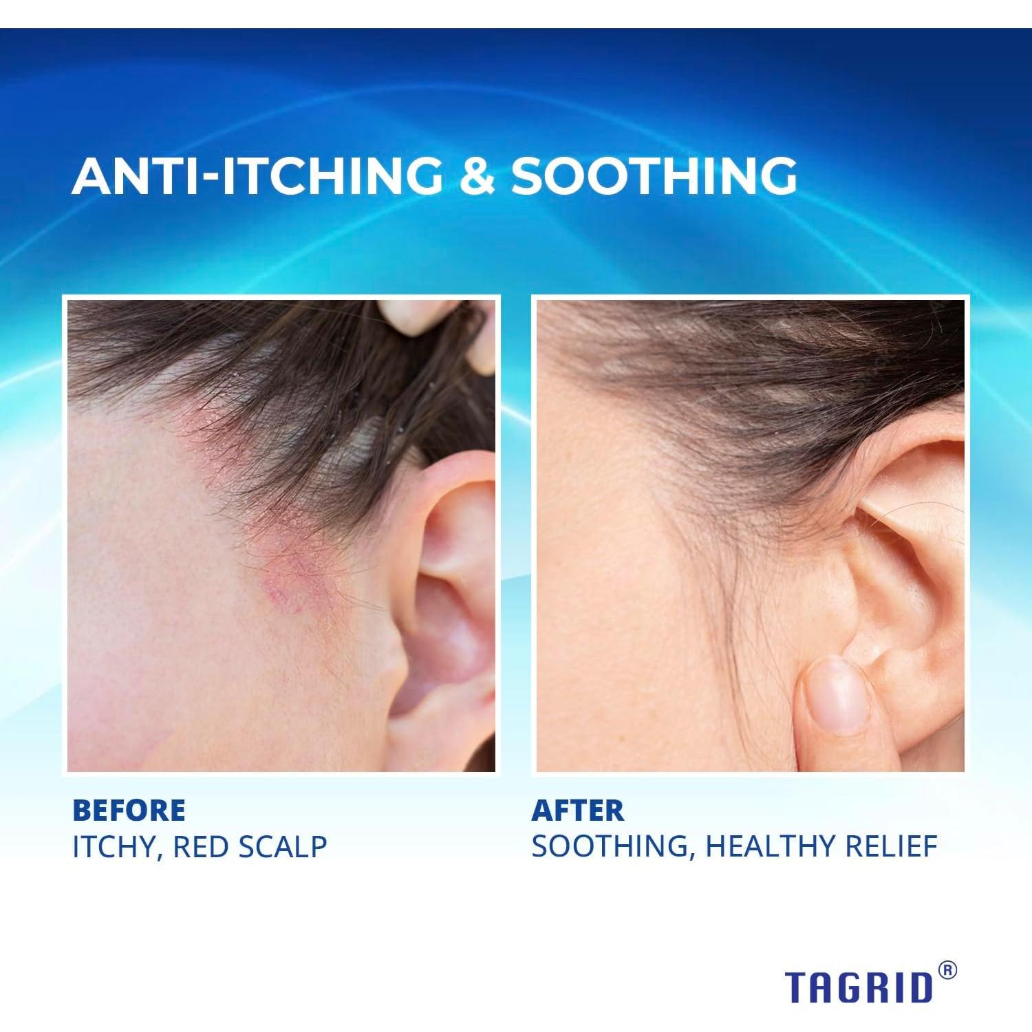 Champú Antifúngico TAGRID 250mL para Psoriasis y Dermatitis