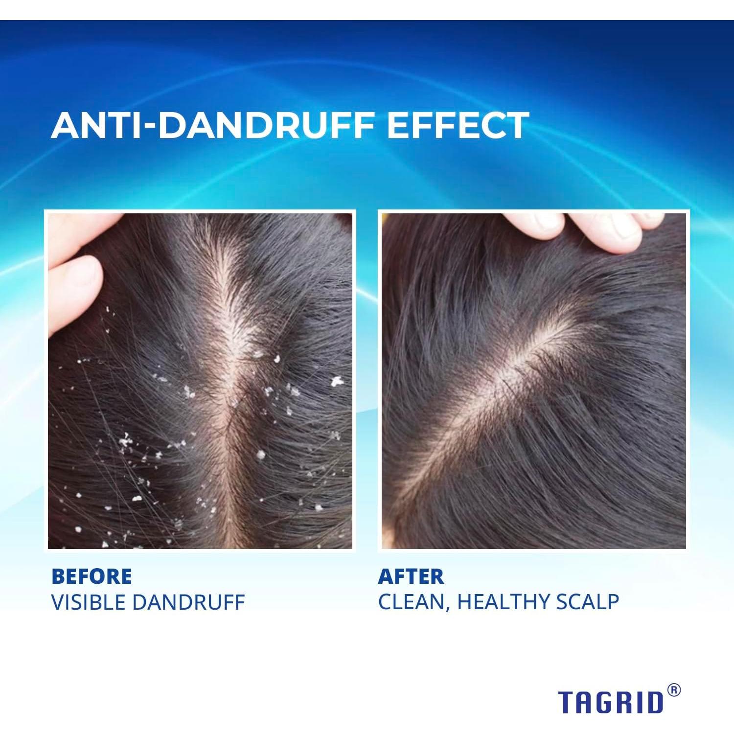 Champú Antifúngico TAGRID 250mL para Psoriasis y Dermatitis