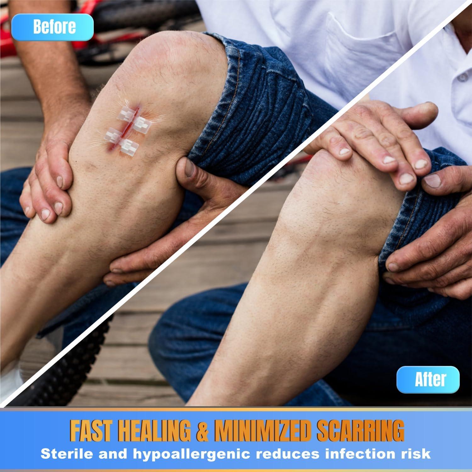 6 Vendajes Mariposa Hons para Cierre Rápido de Heridas