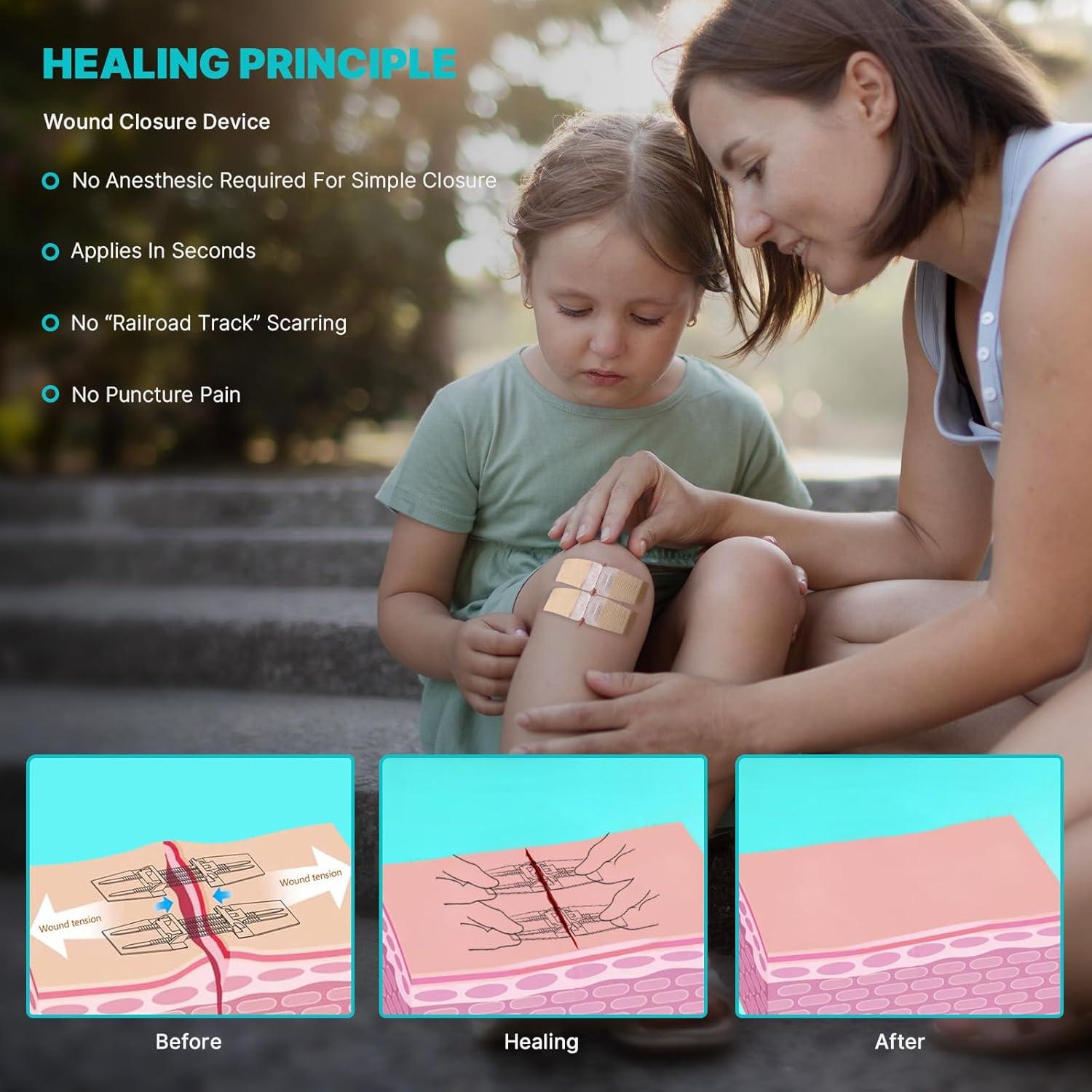 Tiras de Cierre de Heridas NETWALL 10 Pcs 8x2 cm