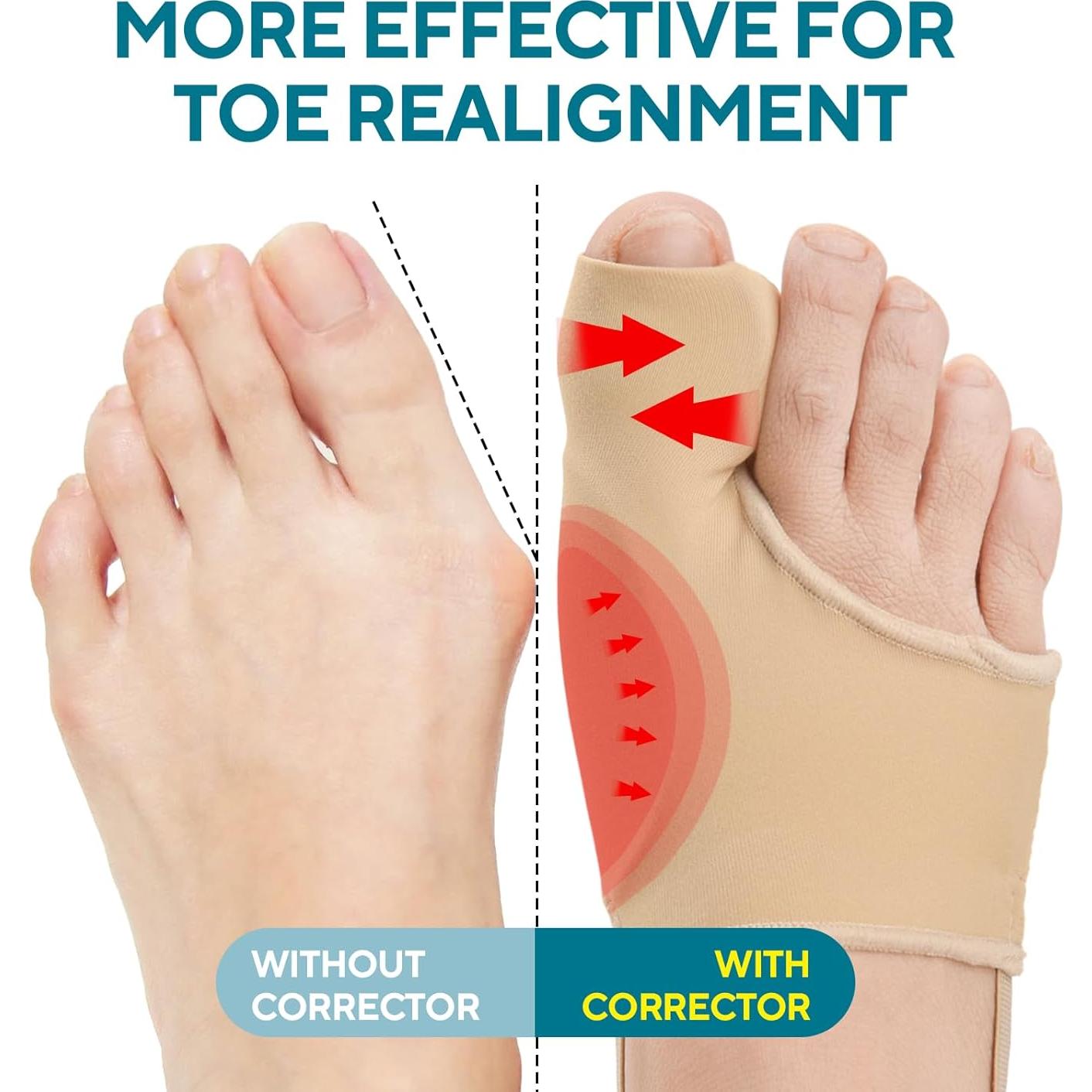 Corrector de Juanetes TECKED Beige - Alivio para Hallux Valgus