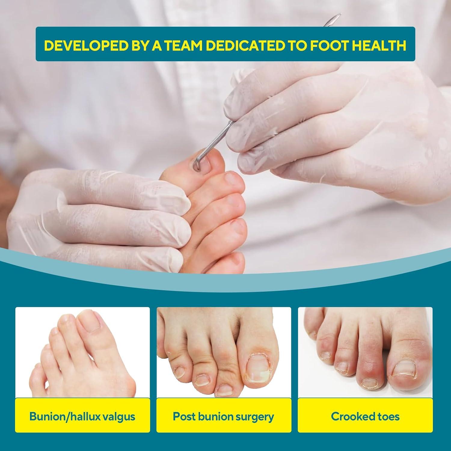 Corrector de Juanetes TECKED Beige - Alivio para Hallux Valgus