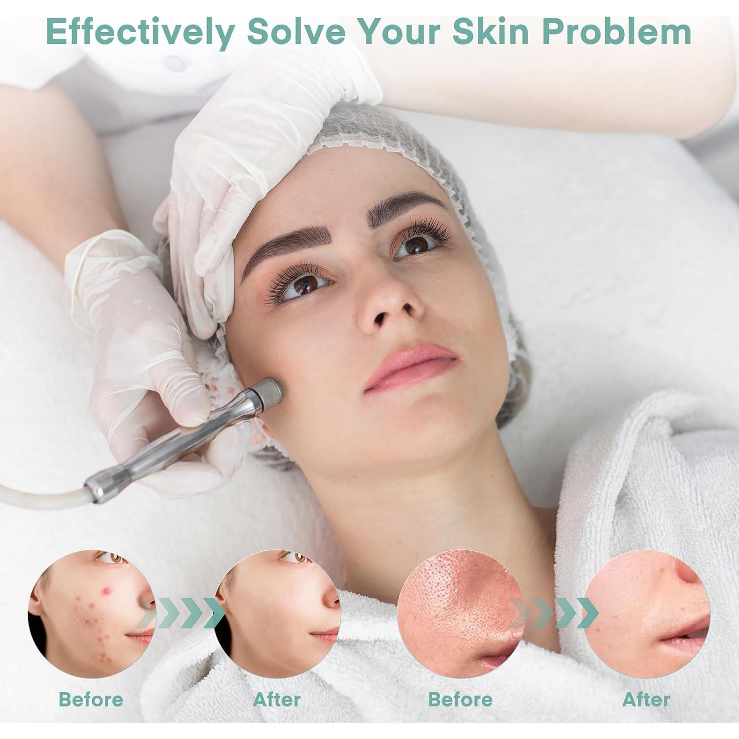 Máquina de Microdermoabrasión Yofuly 2 en 1 para Peeling Facial