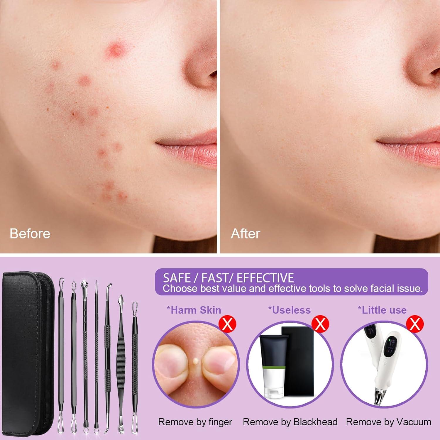 Kit de Herramientas para Remover Puntos Negros Teenitor 7 en 1