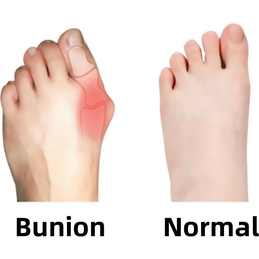 Cinta Kinesiológica Precortada IEADEN para Juanetes 40 Pcs